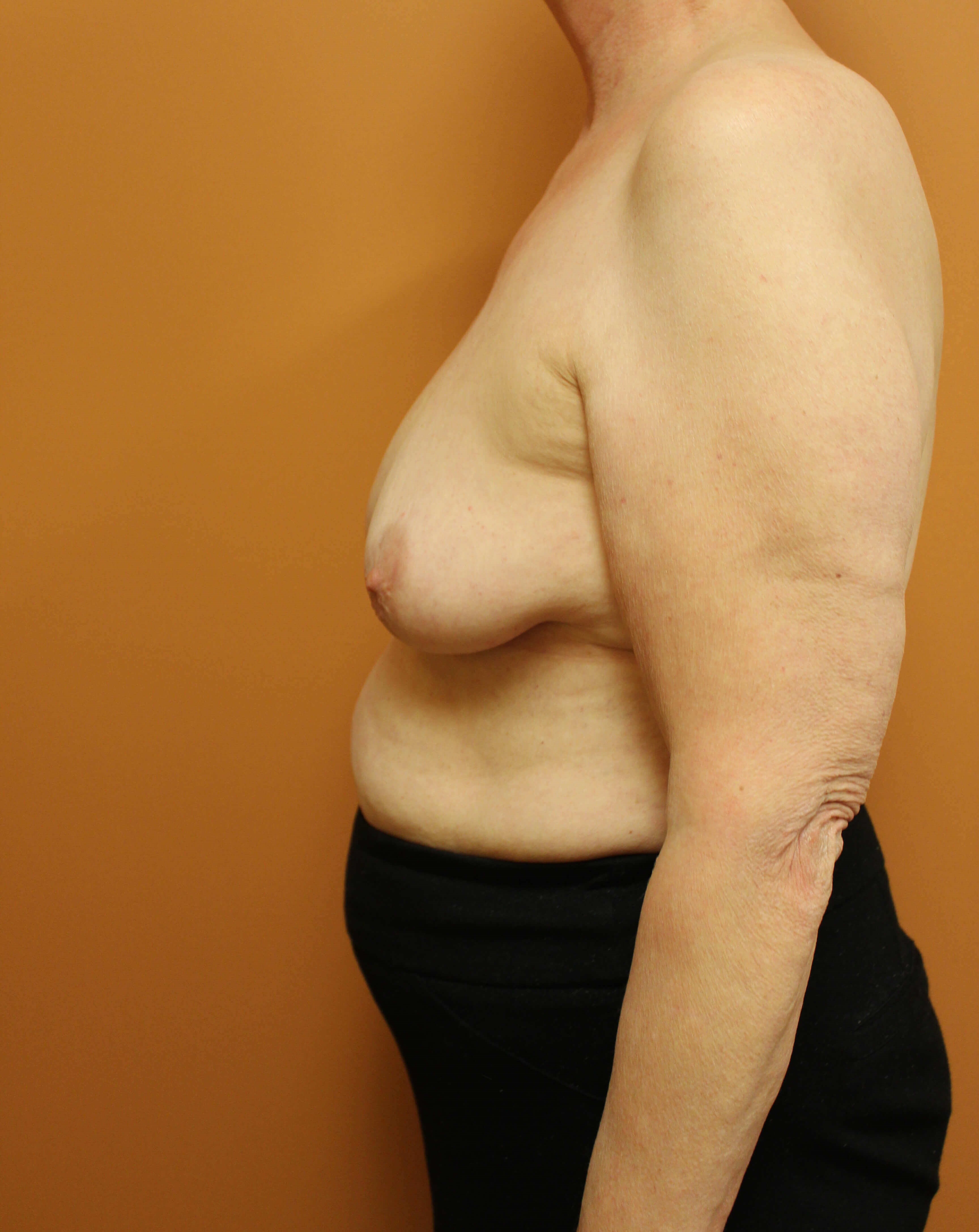 Oncoplastic Reduction Before