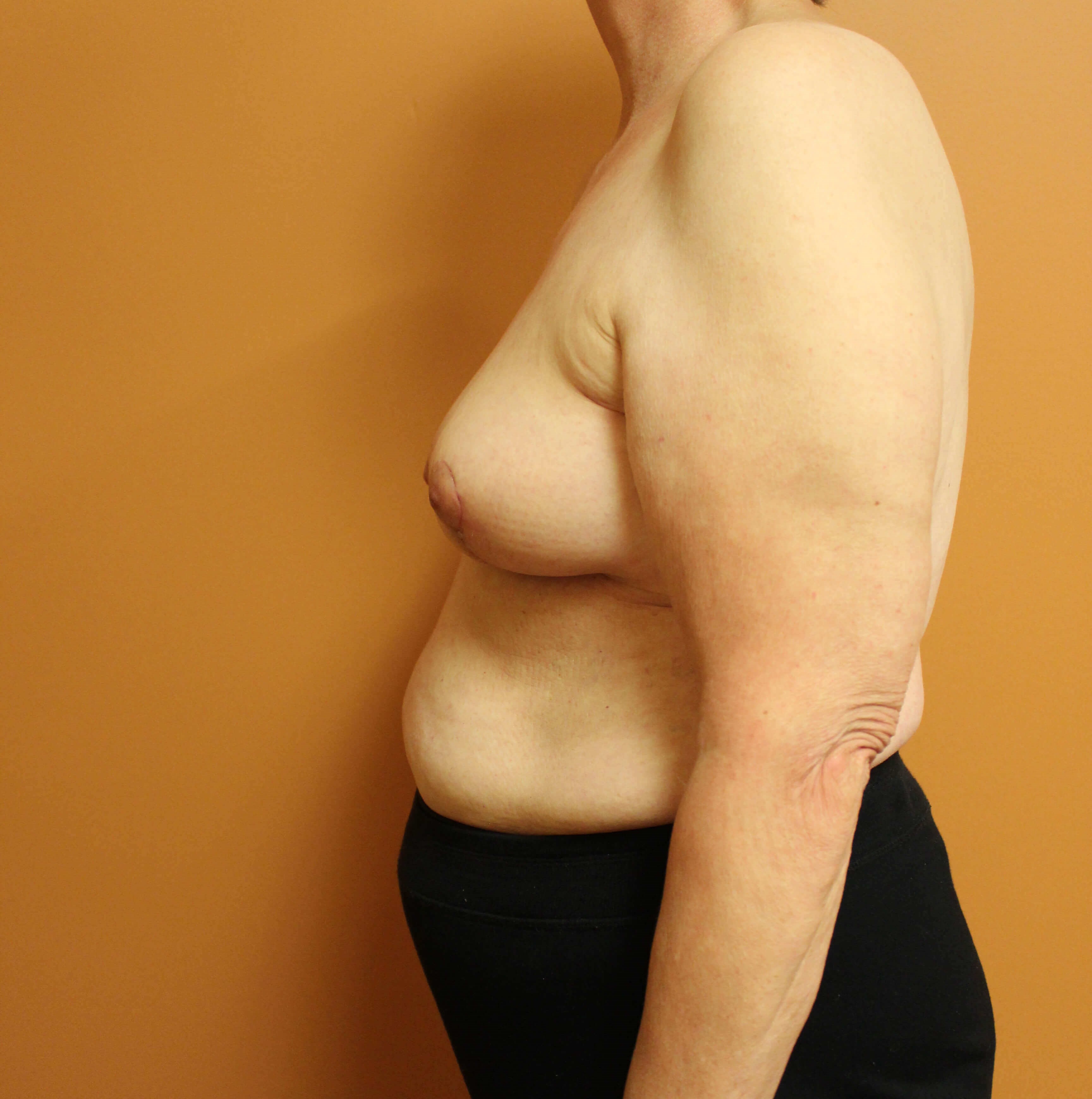 Oncoplastic Reduction After