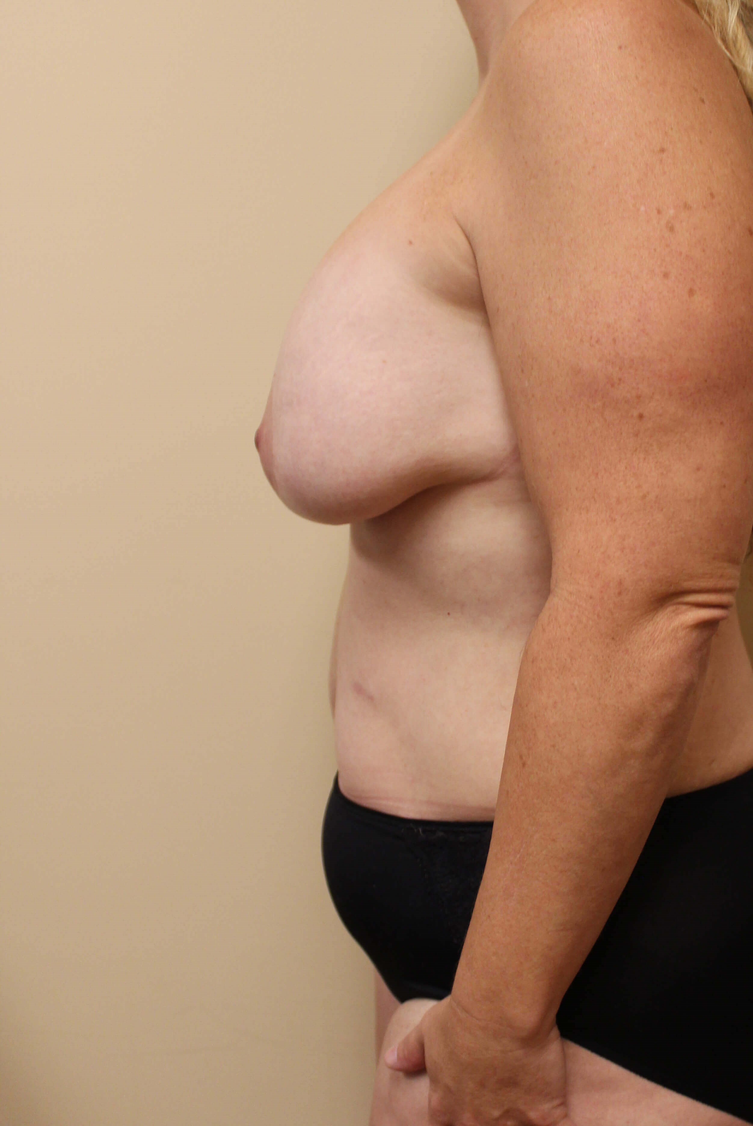 Mommy Makeover Surgery Before