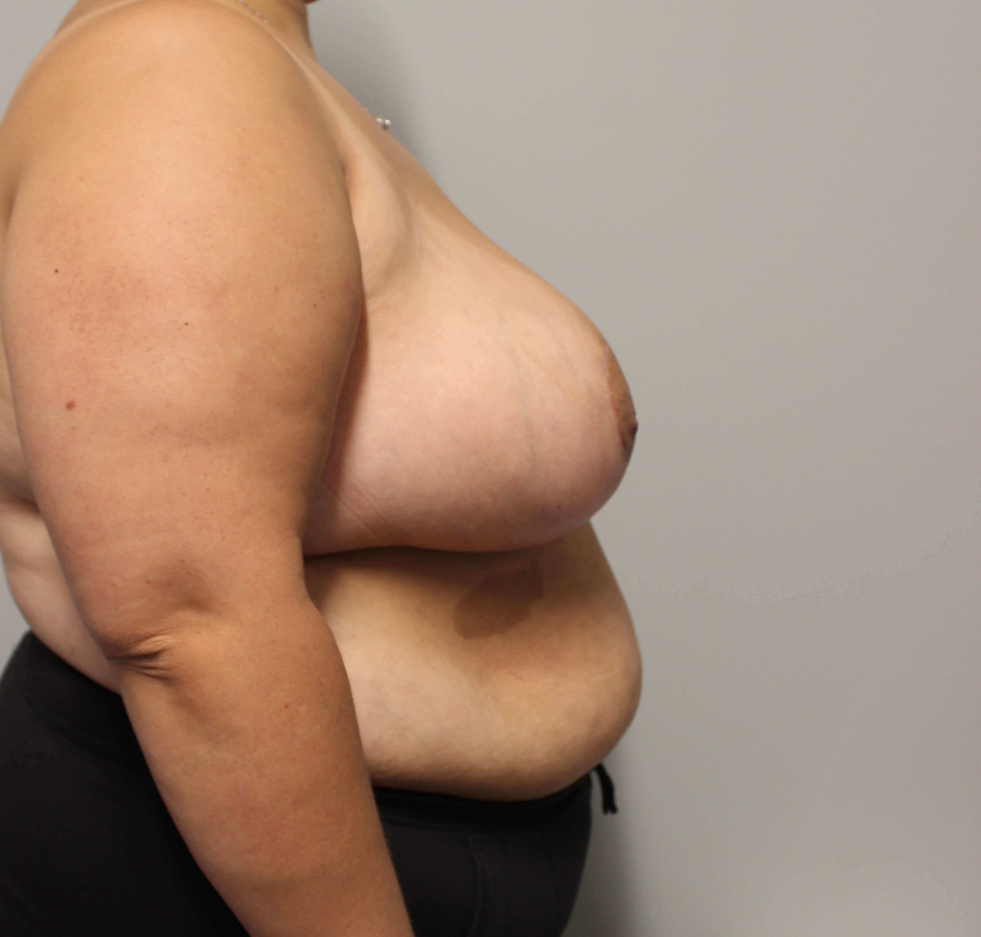 Breast Reduction Surgery After