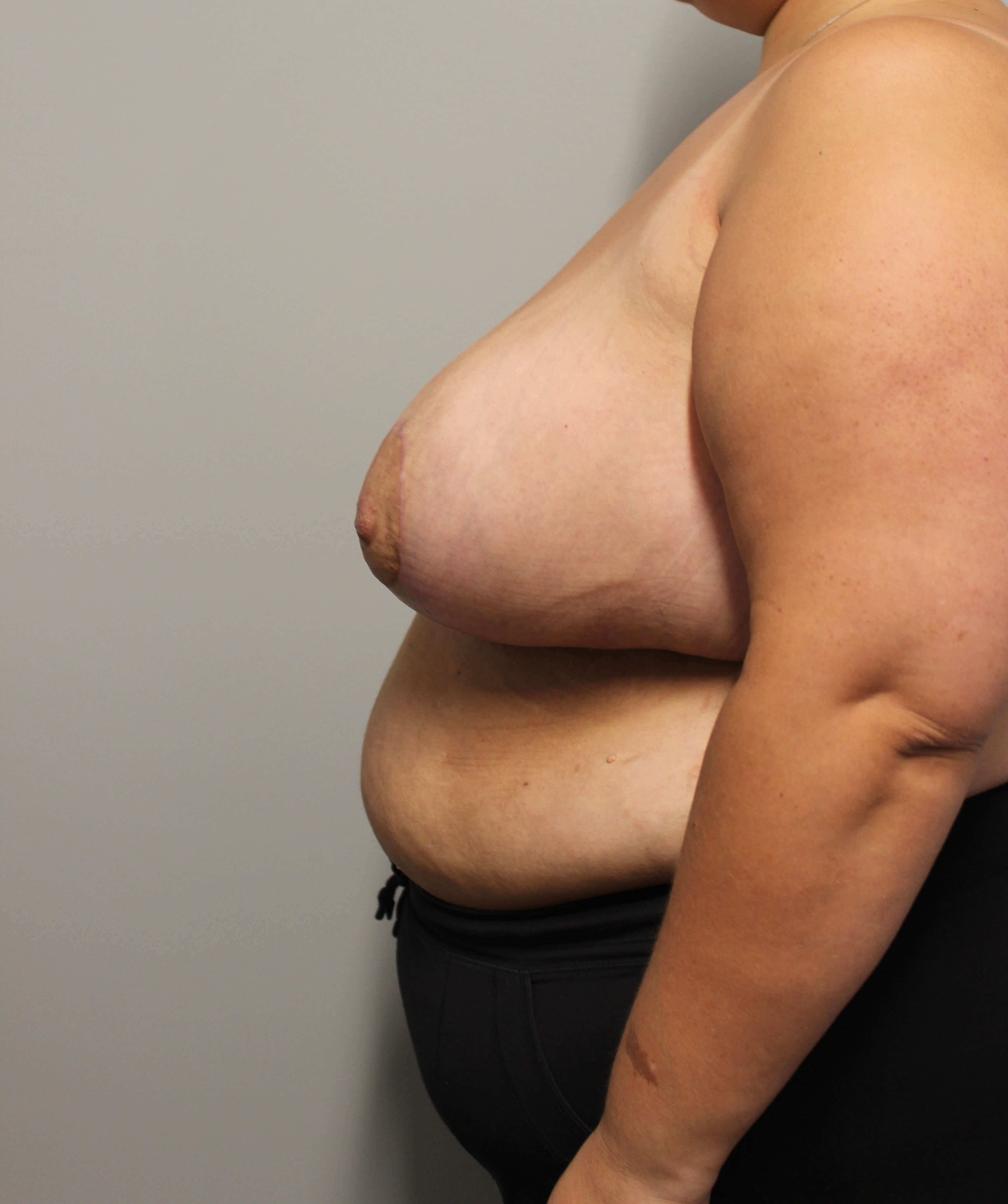 Breast Reduction Surgery After