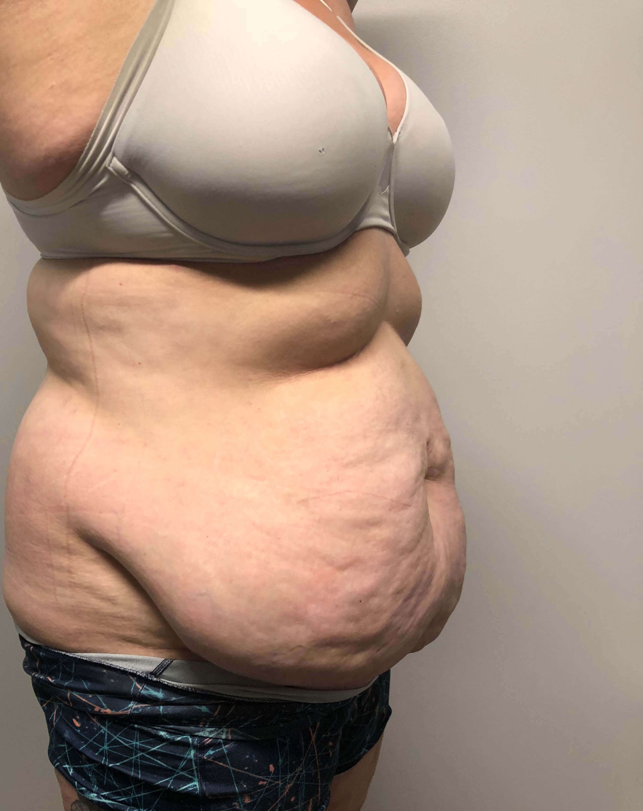 Tummy Tuck after weight loss Before
