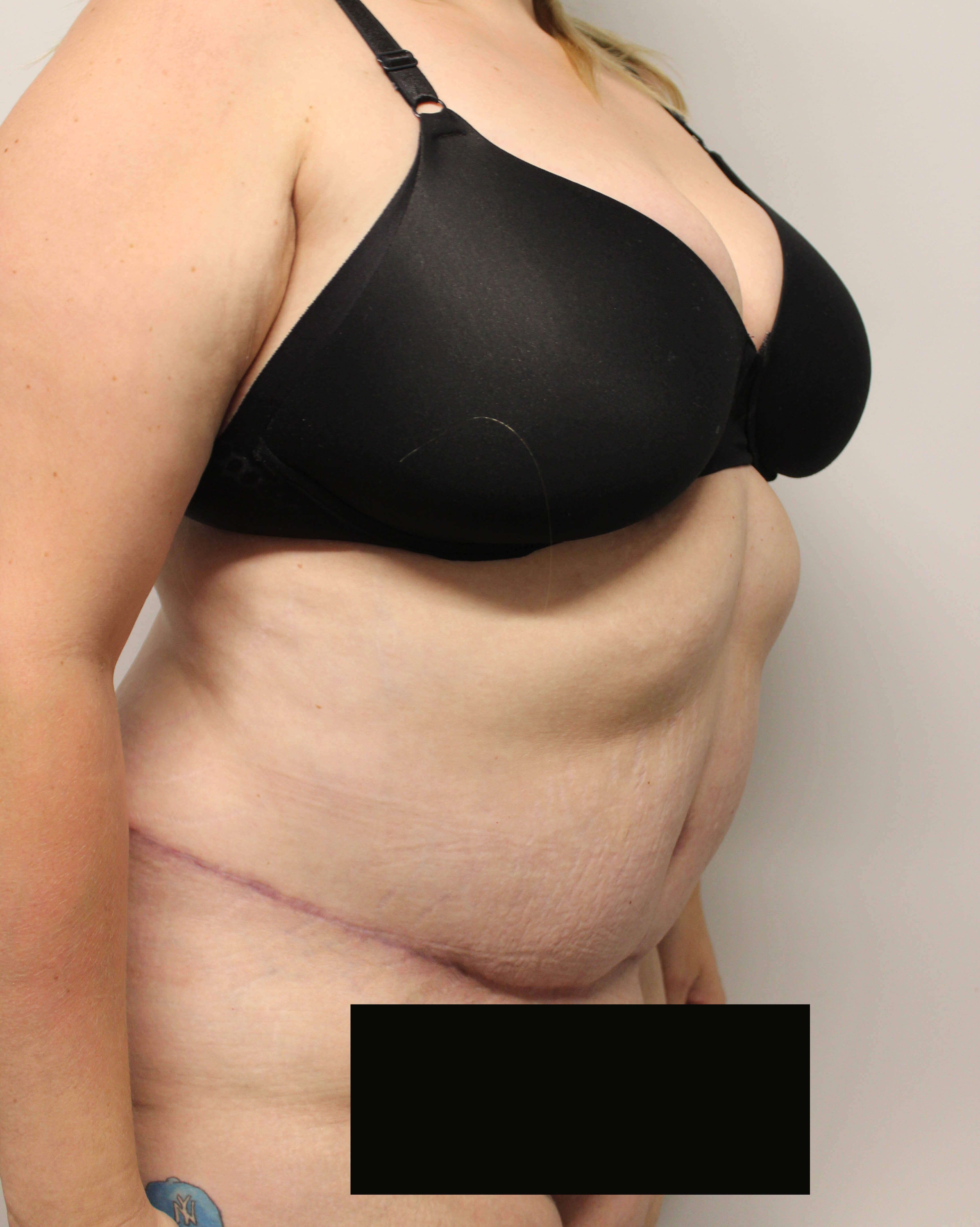 Tummy Tuck after weight loss After