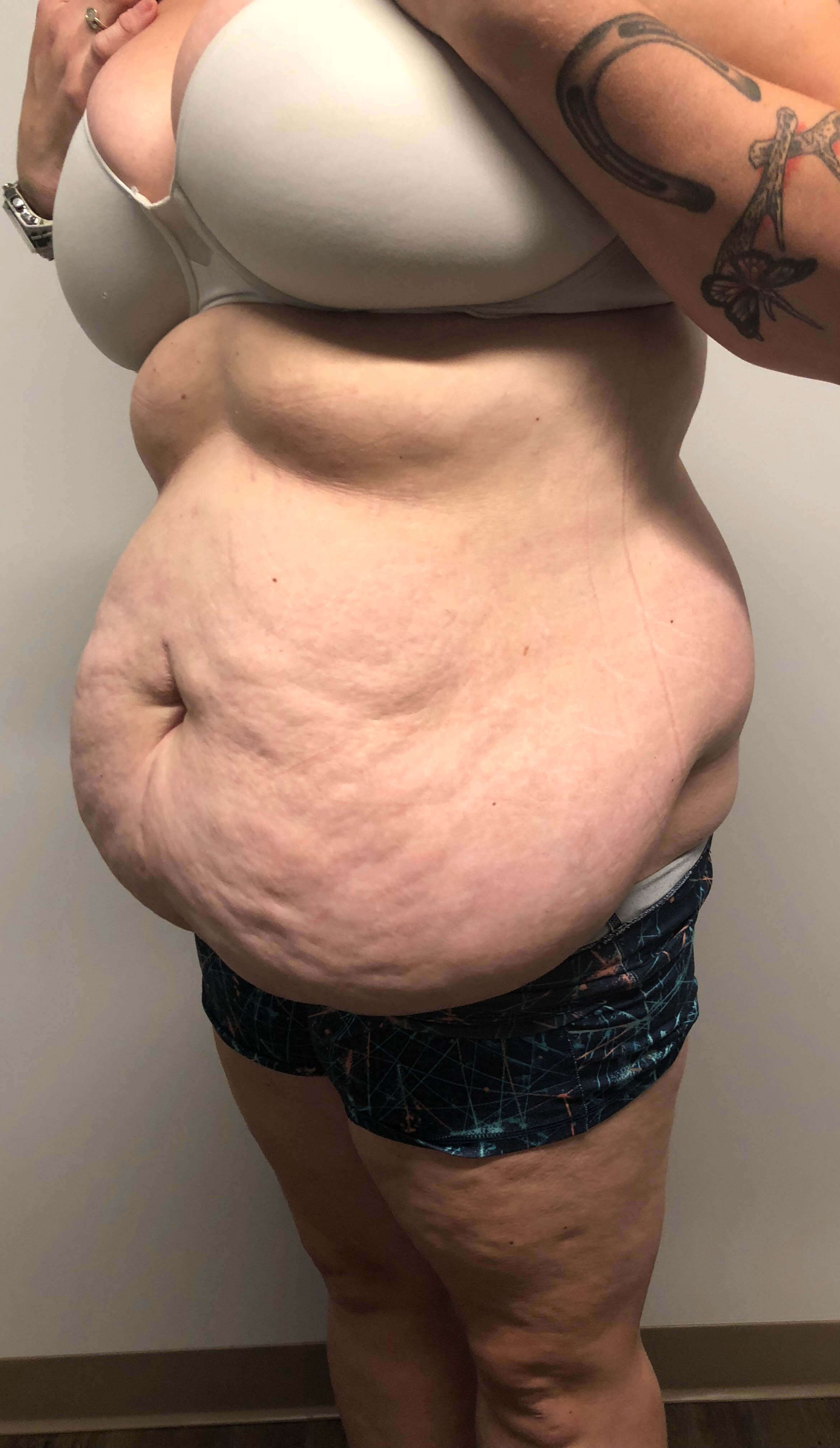 Tummy Tuck after weight loss Before