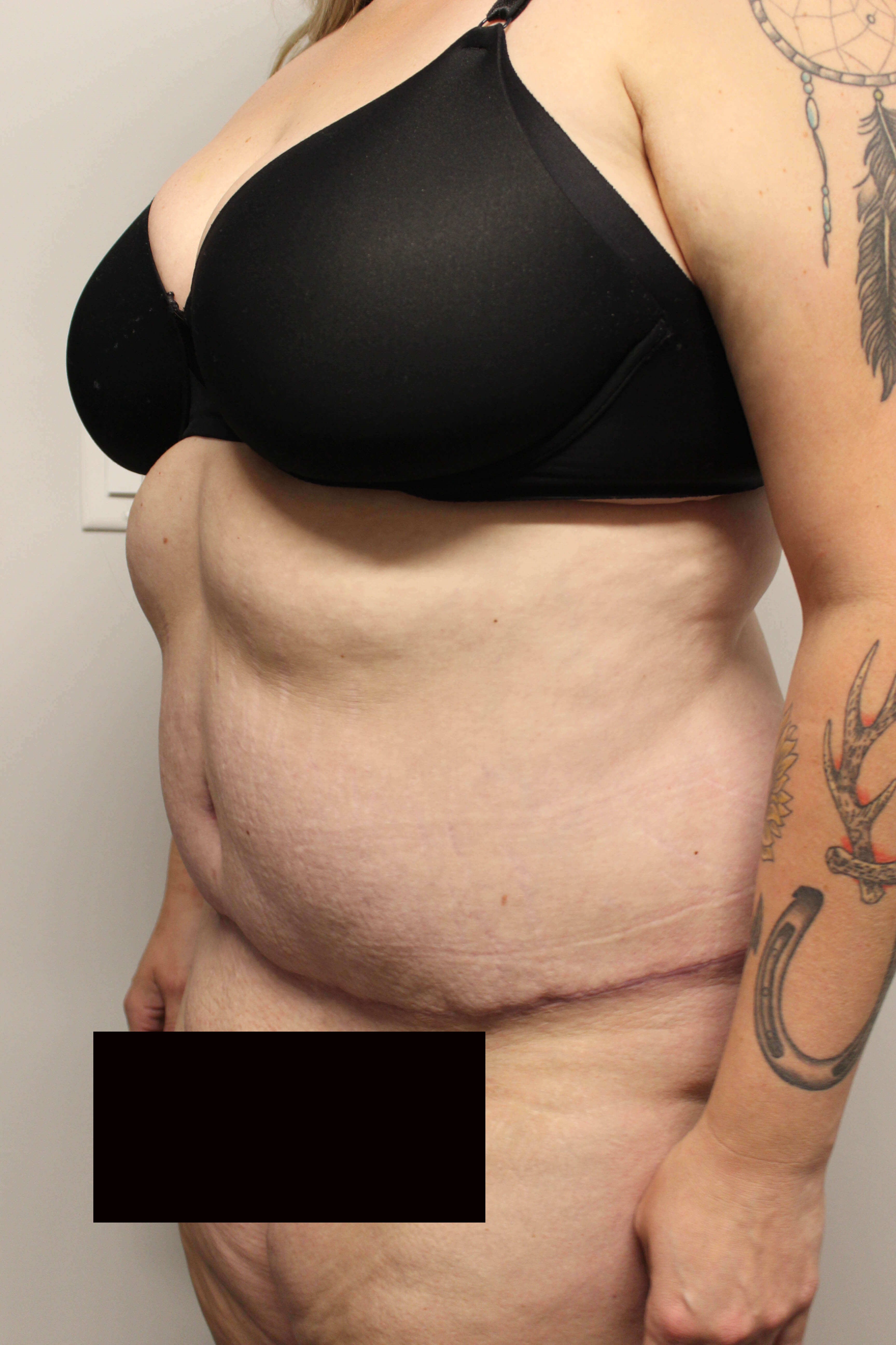 Tummy Tuck after weight loss After