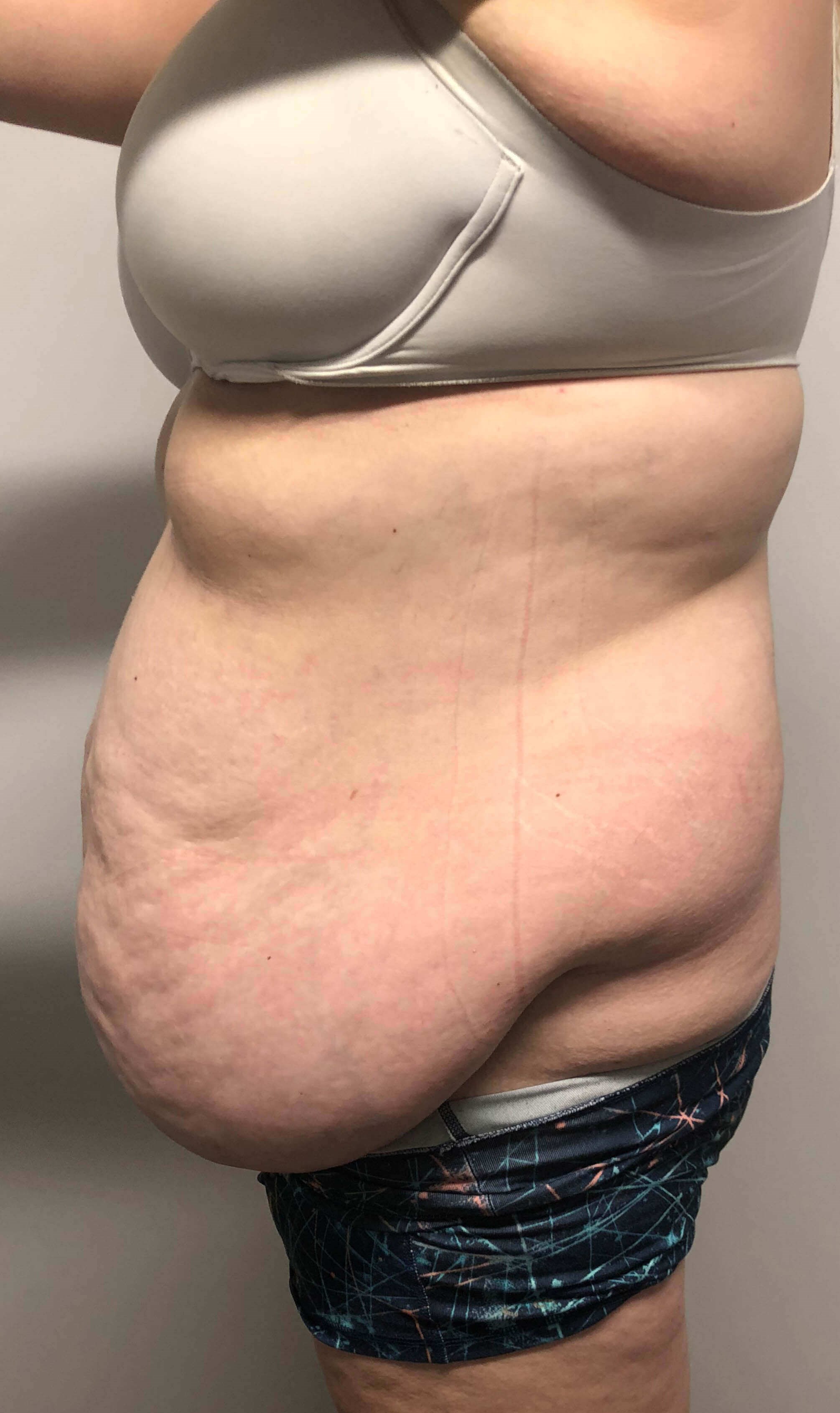 Tummy Tuck after weight loss Before