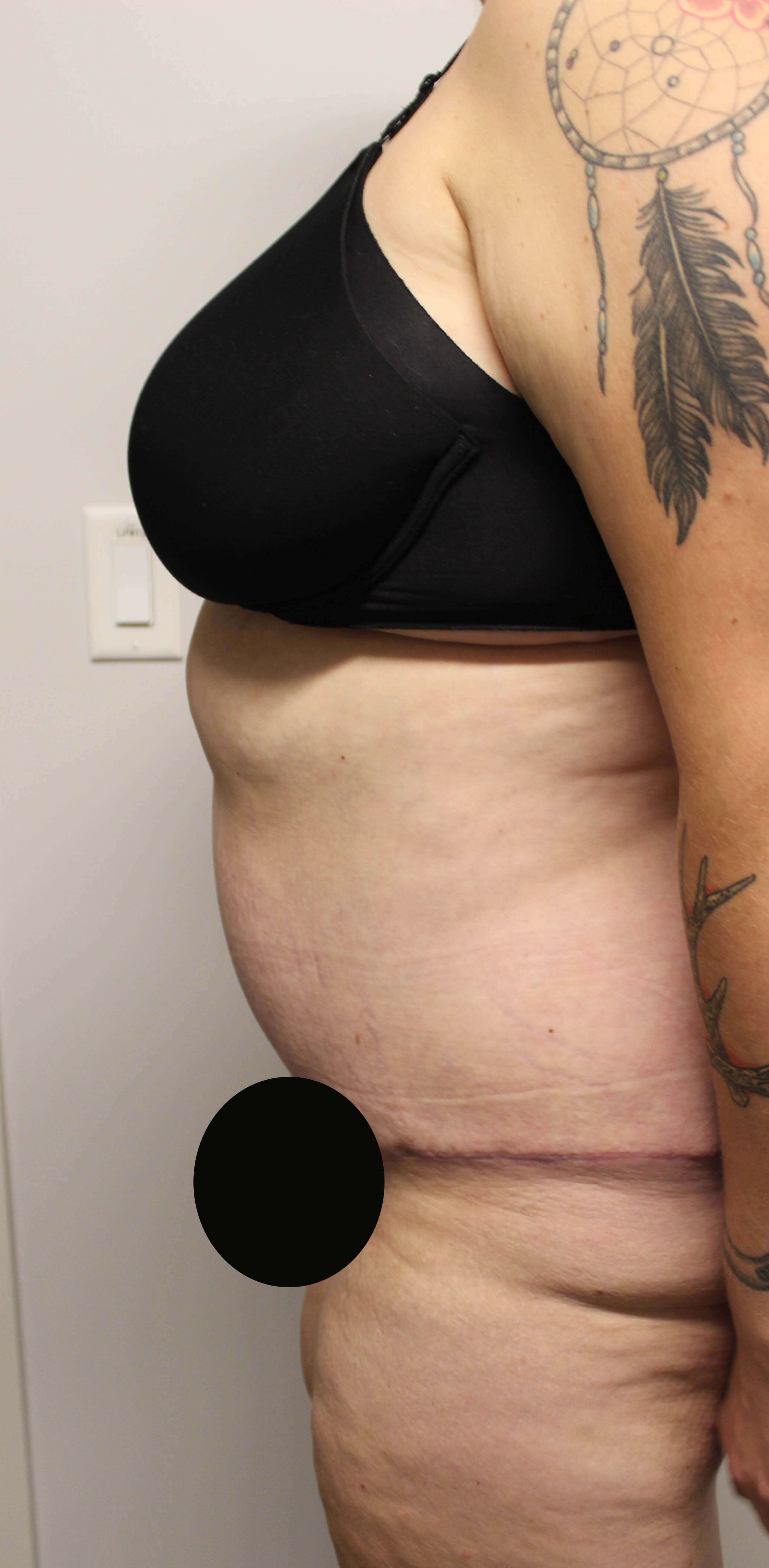 Tummy Tuck after weight loss After