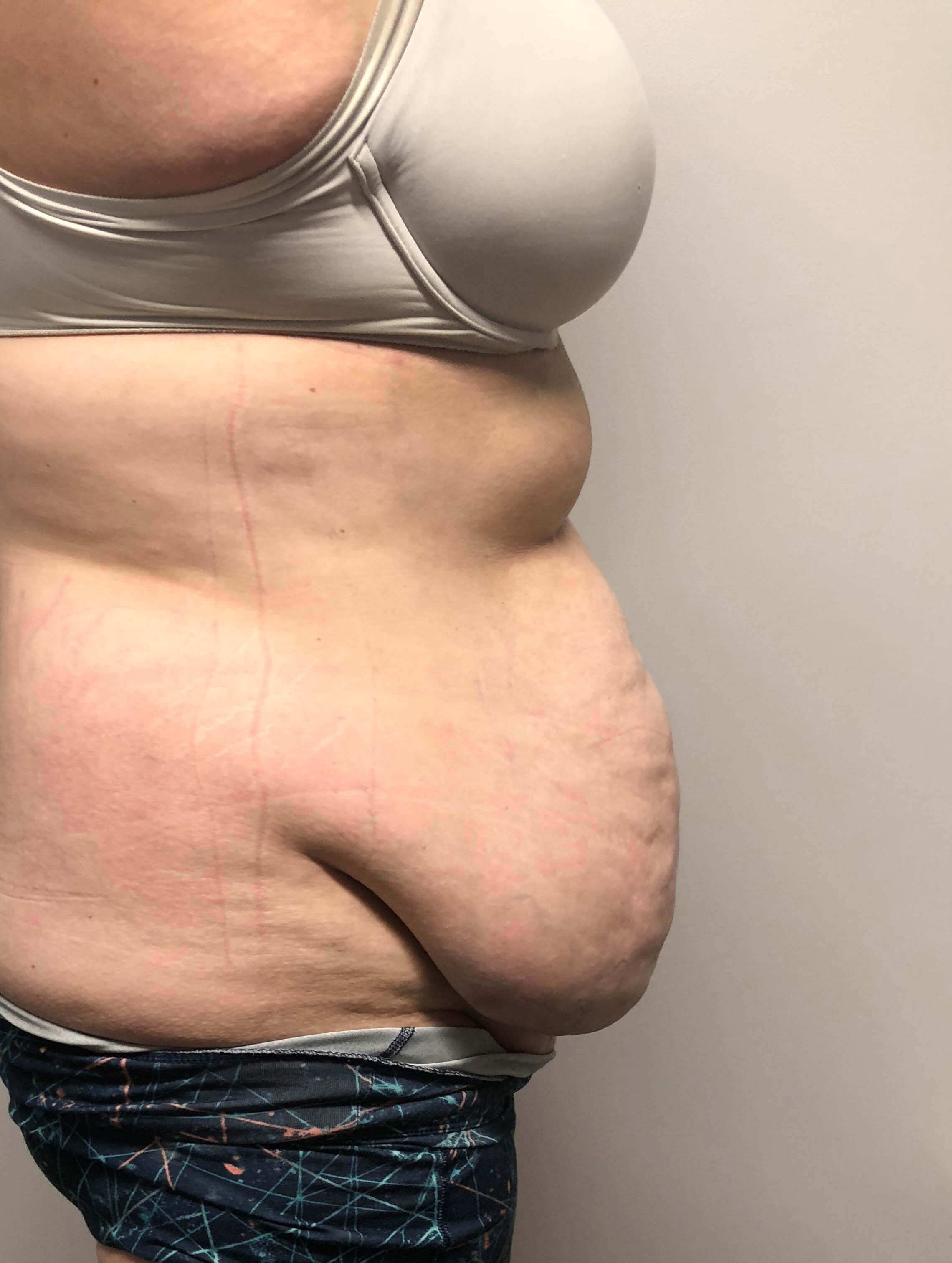 Tummy Tuck after weight loss Before