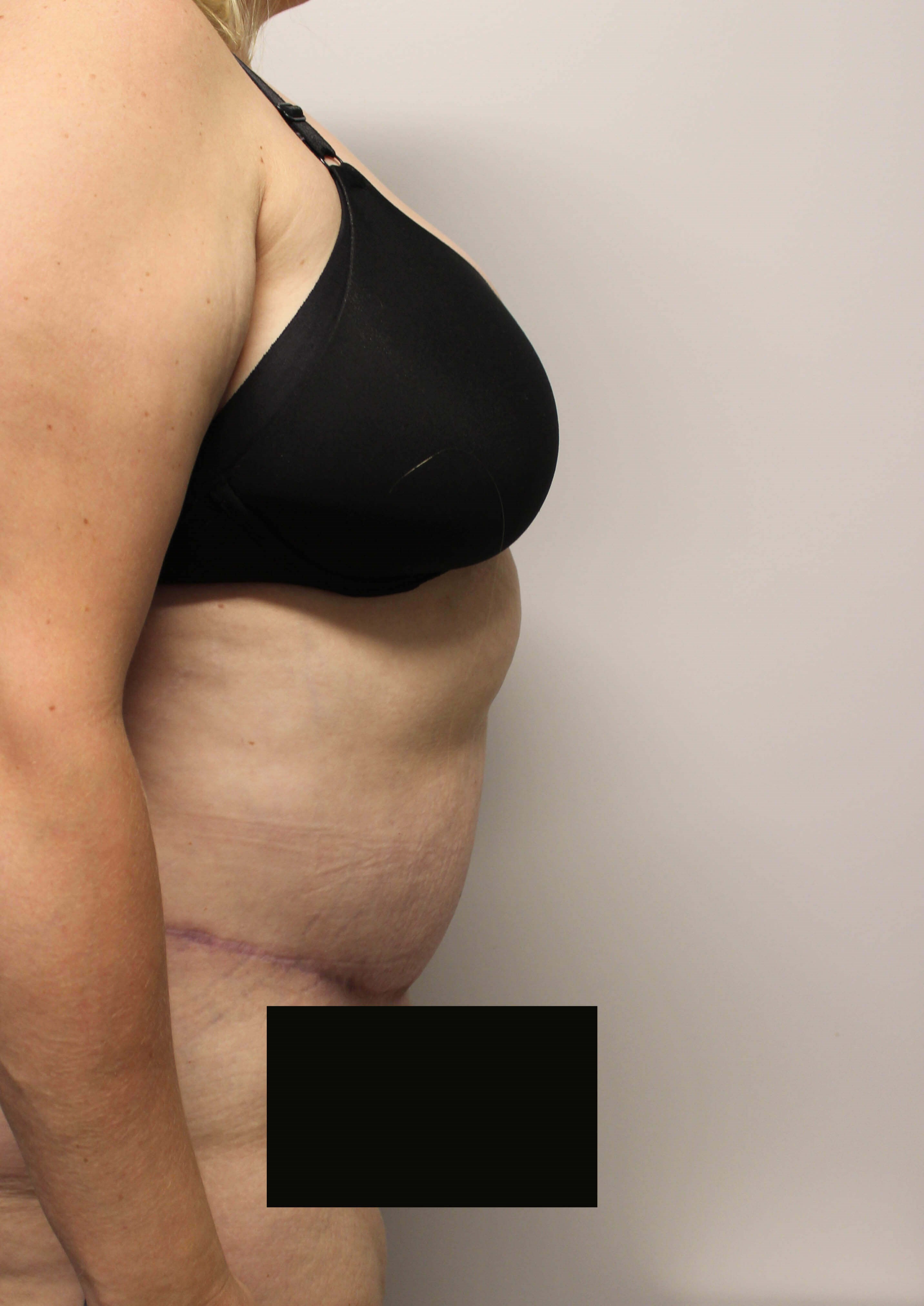 Tummy Tuck after weight loss After