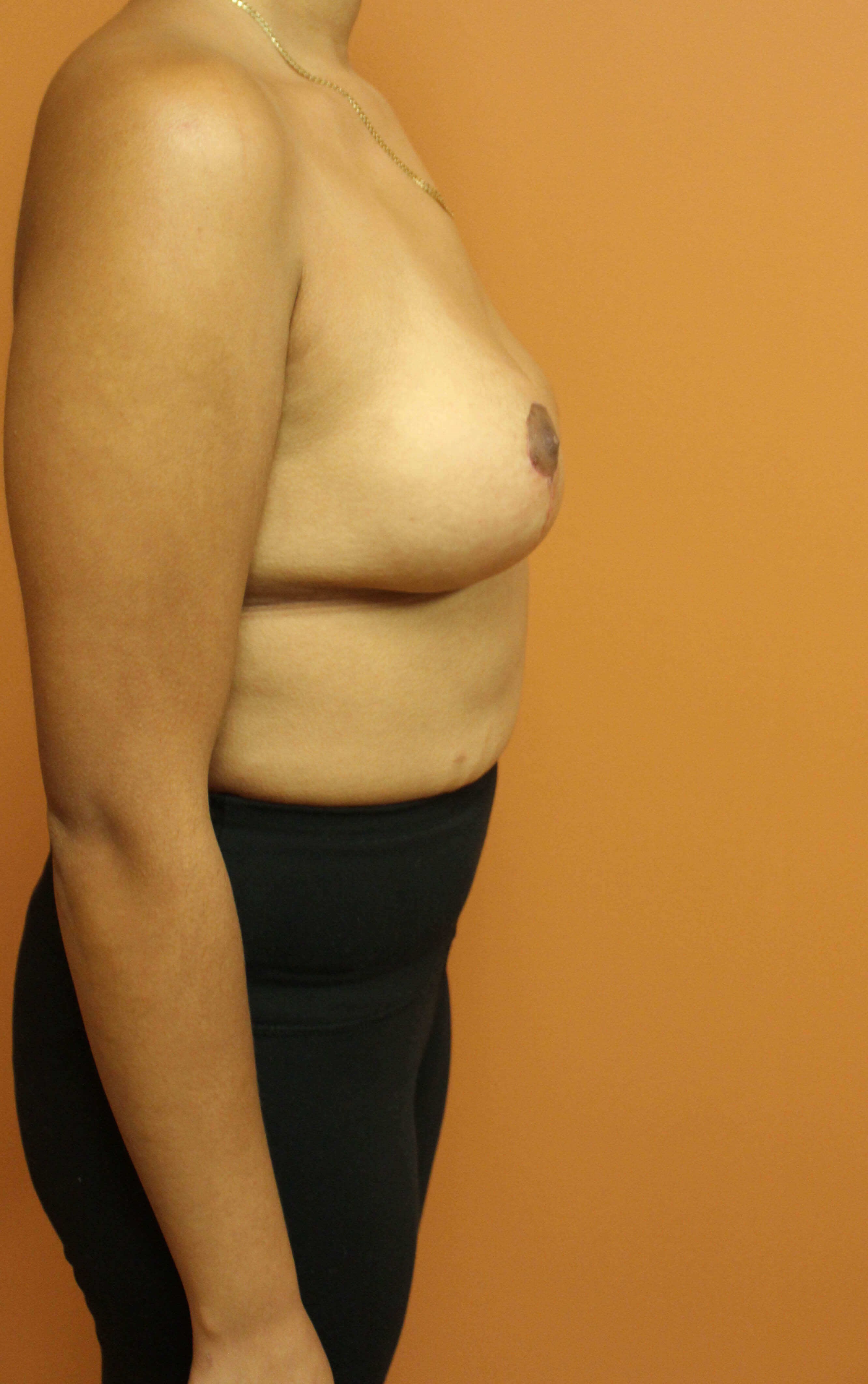 Breast Reduction Surgery After