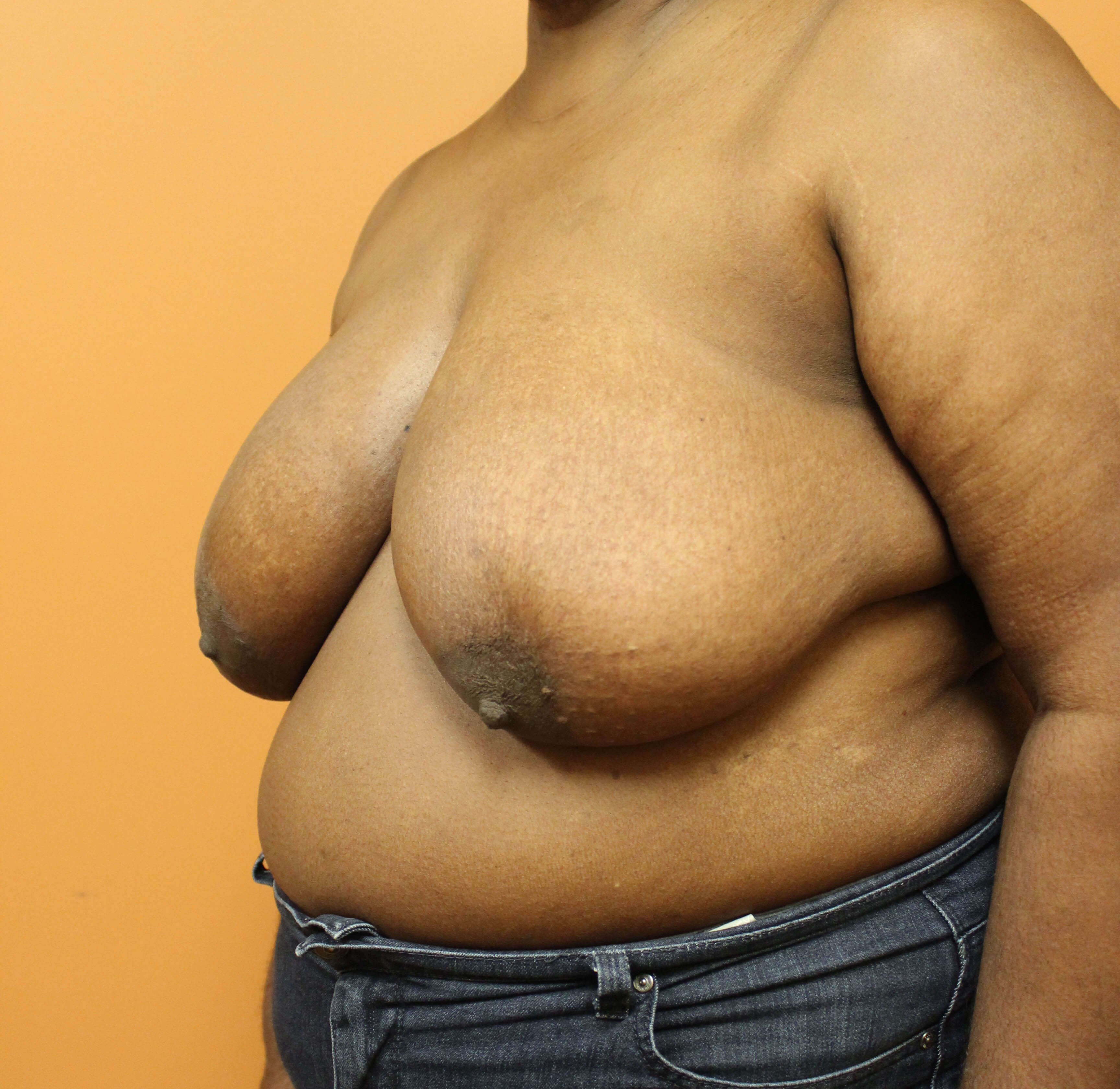 Oncoplastic Breast Reduction Before