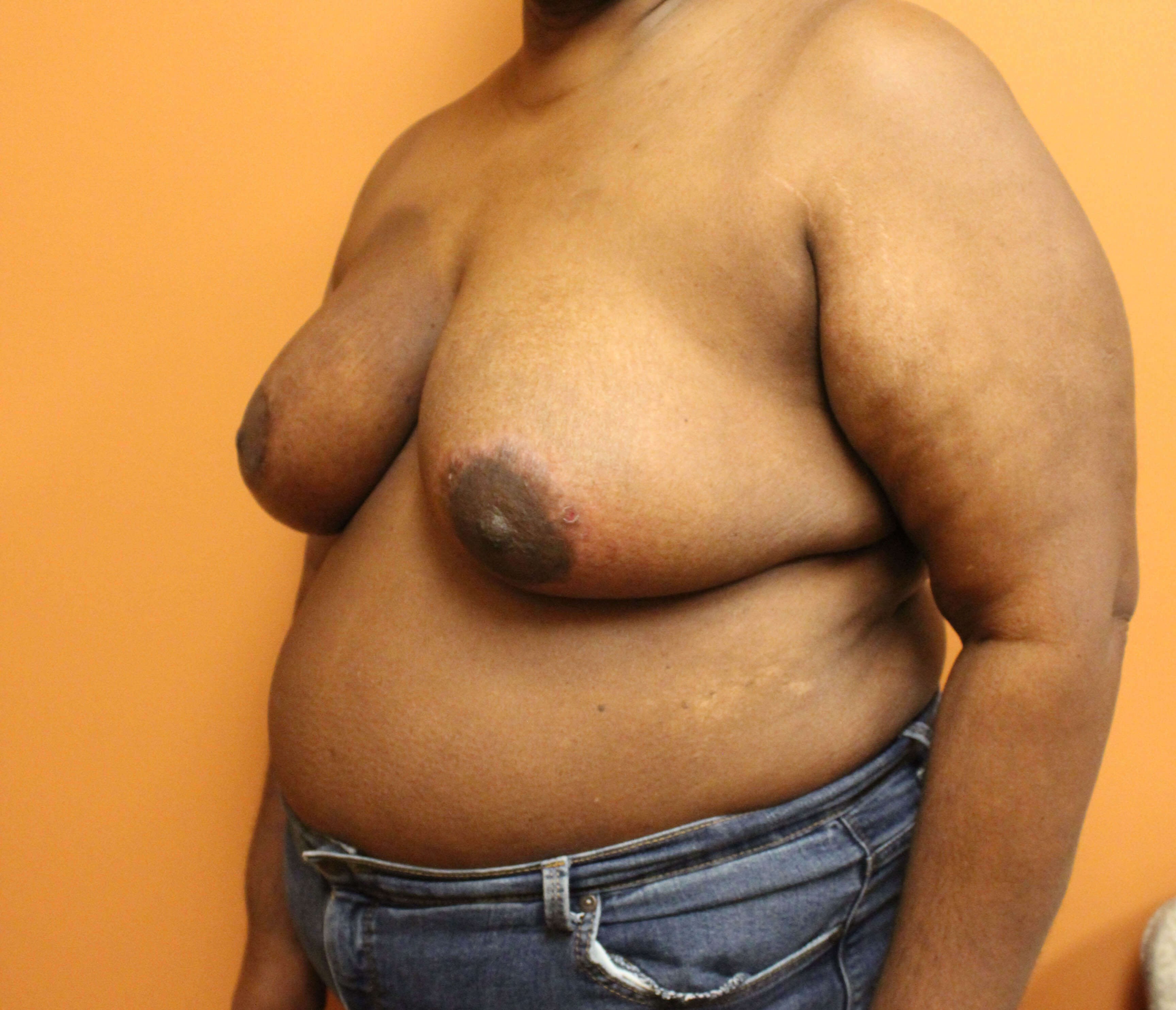 Oncoplastic Breast Reduction After
