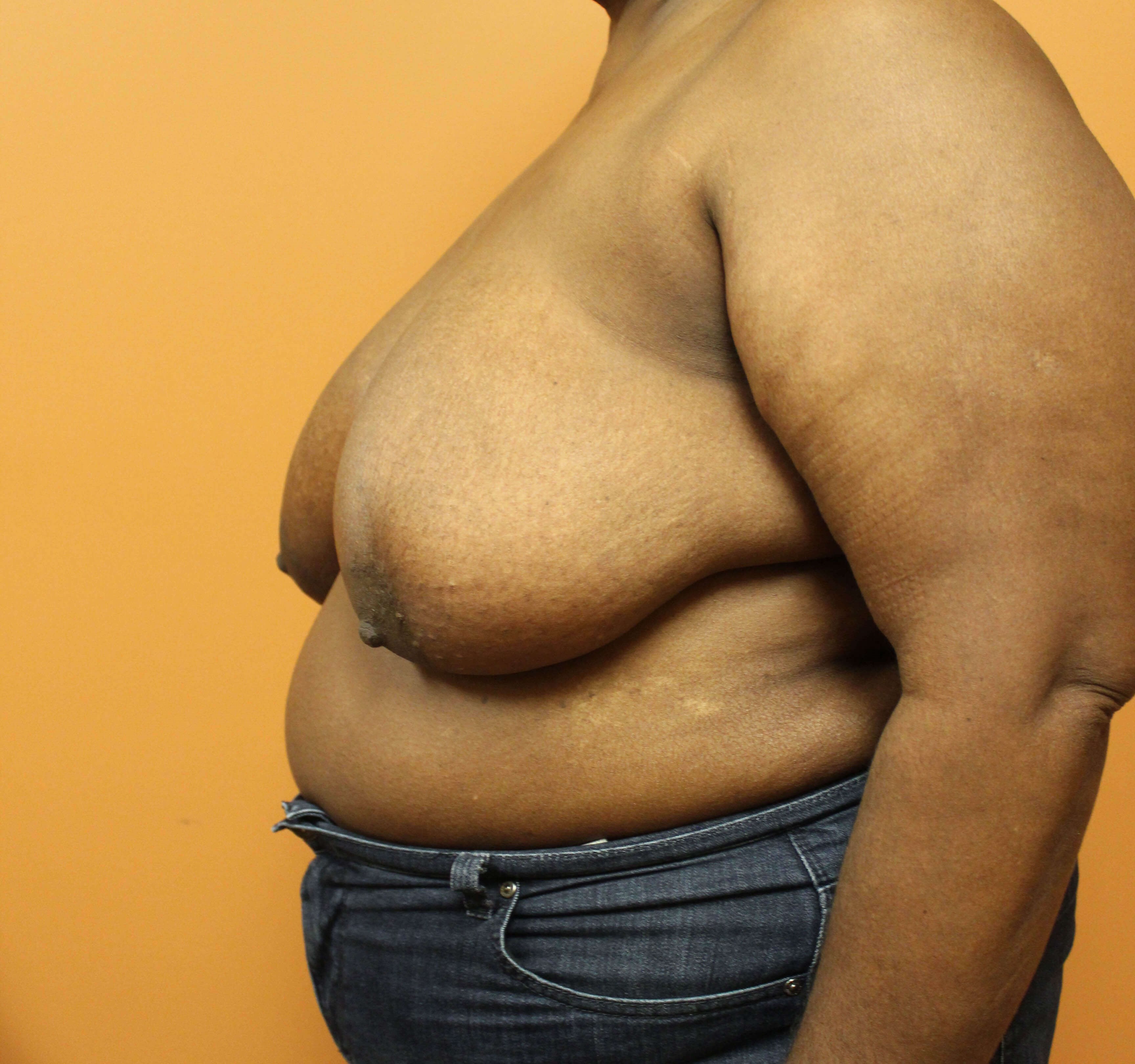 Oncoplastic Breast Reduction Before