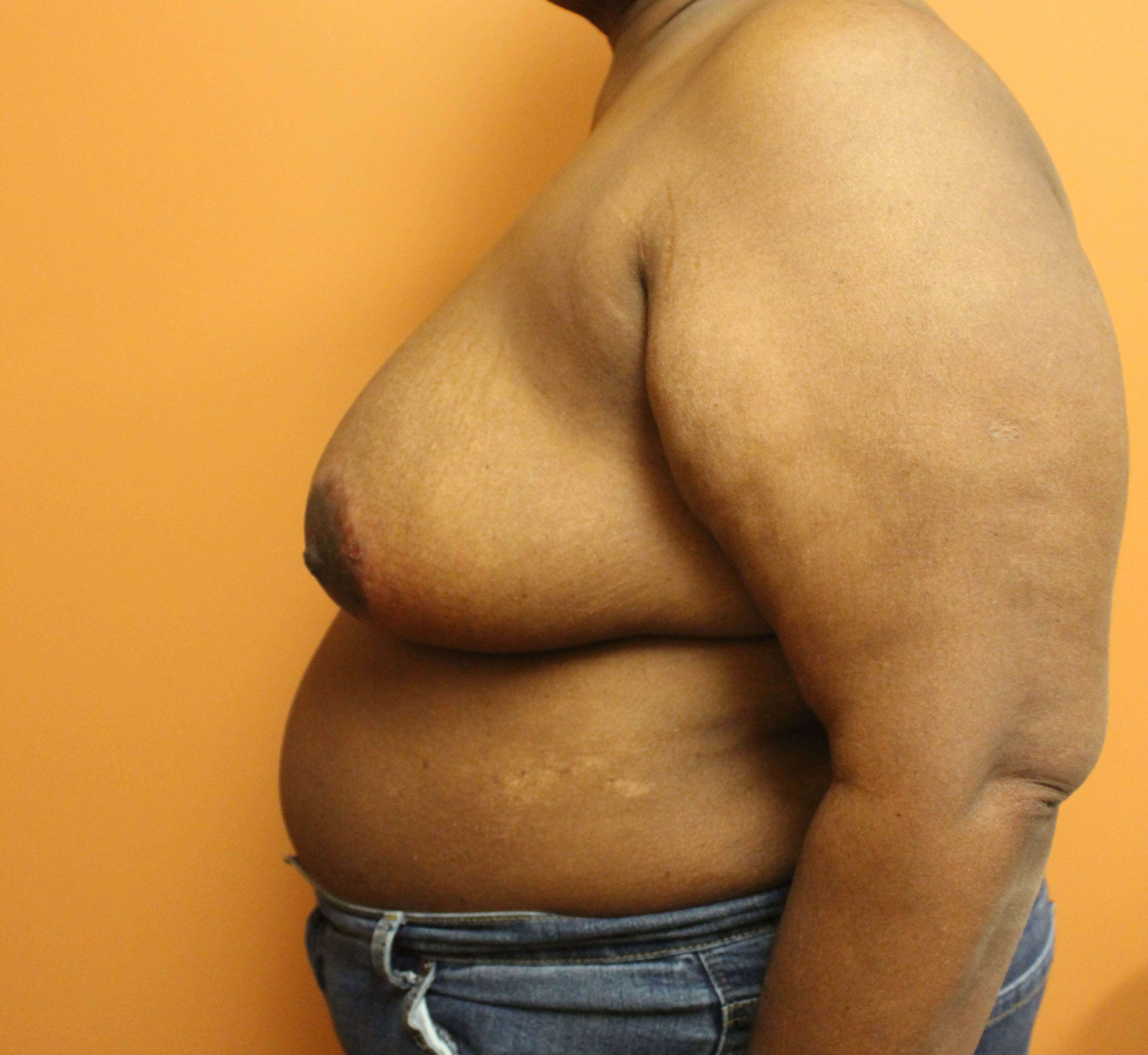 Oncoplastic Breast Reduction After