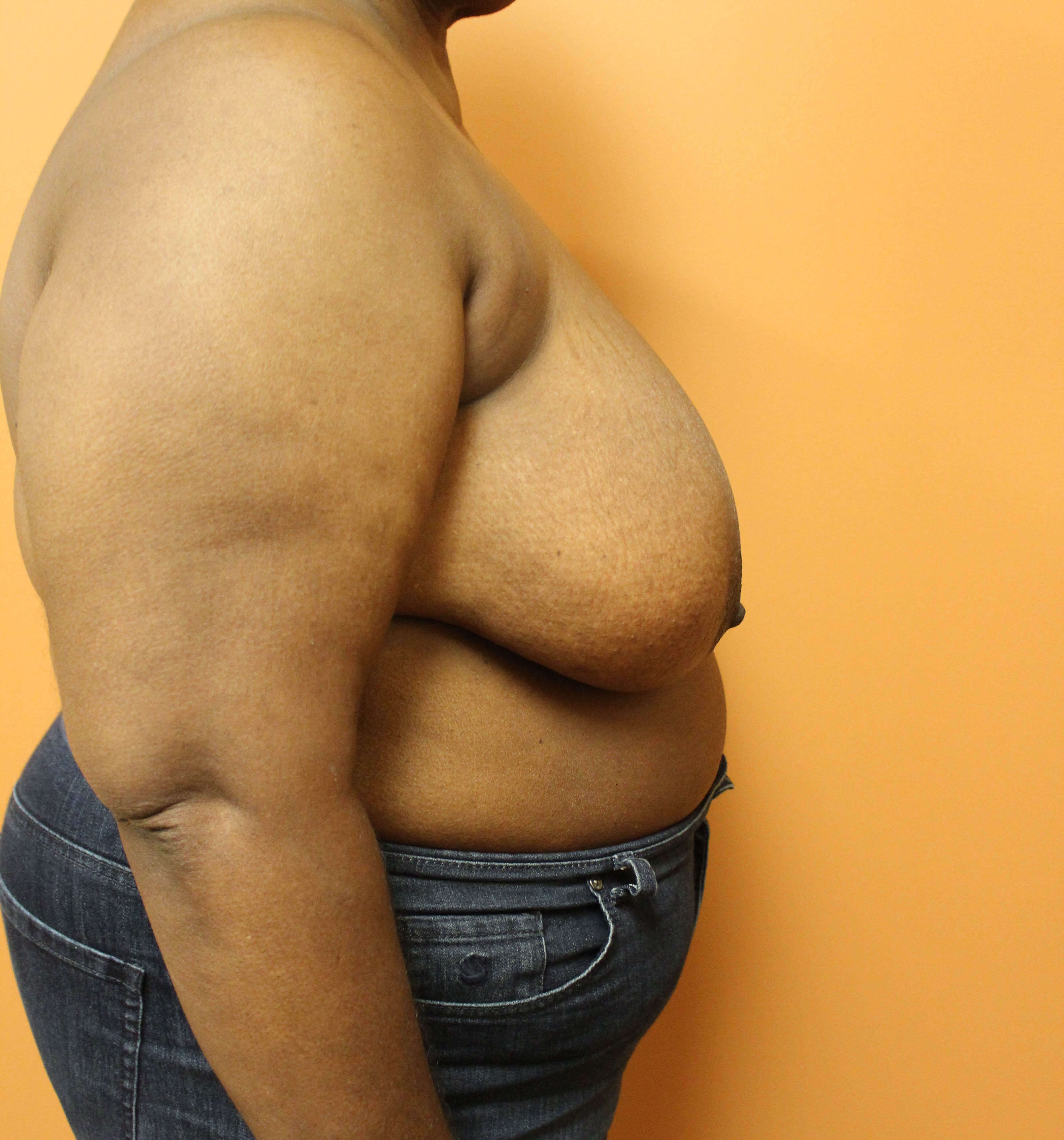 Oncoplastic Breast Reduction Before