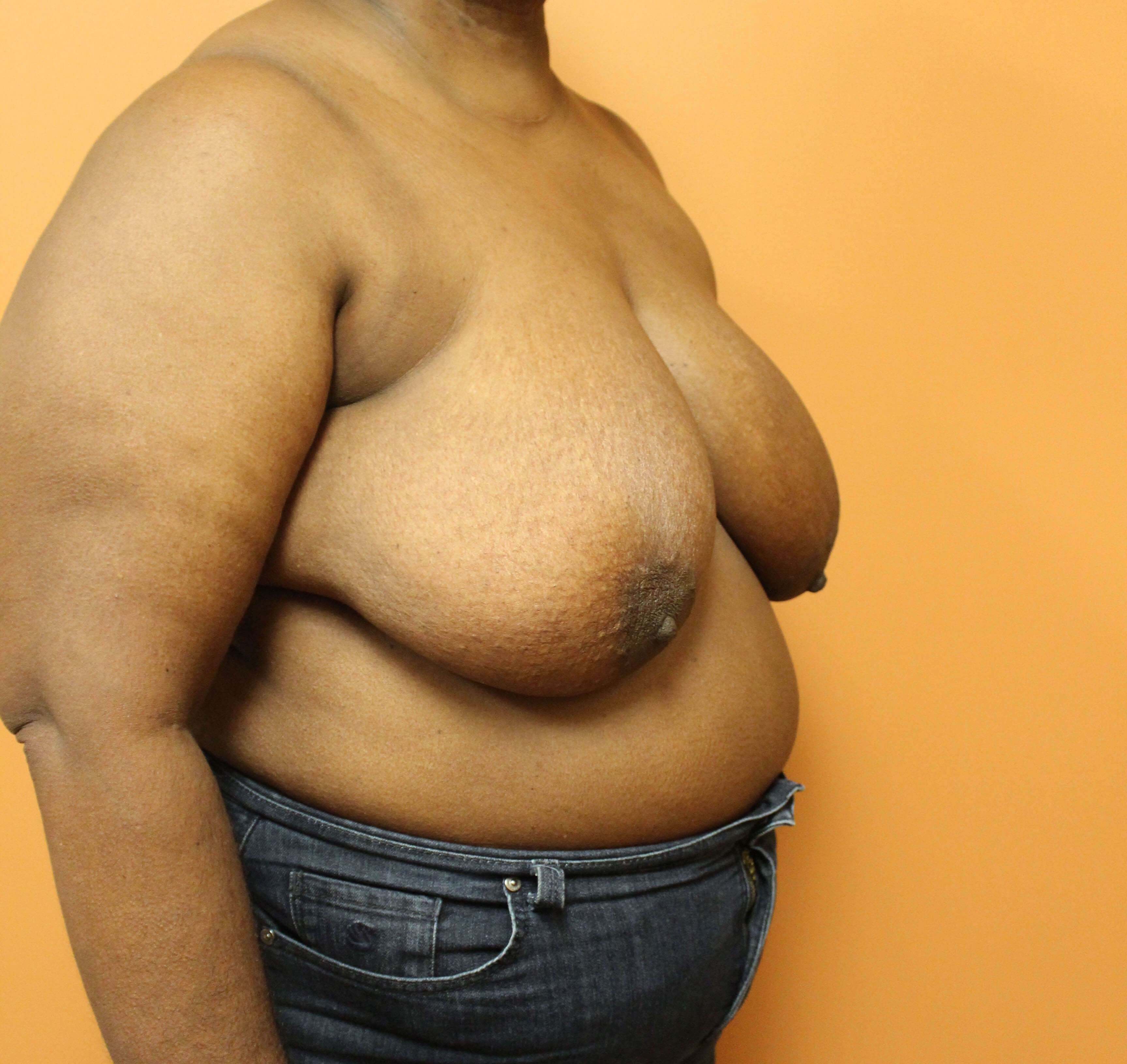 Oncoplastic Breast Reduction Before
