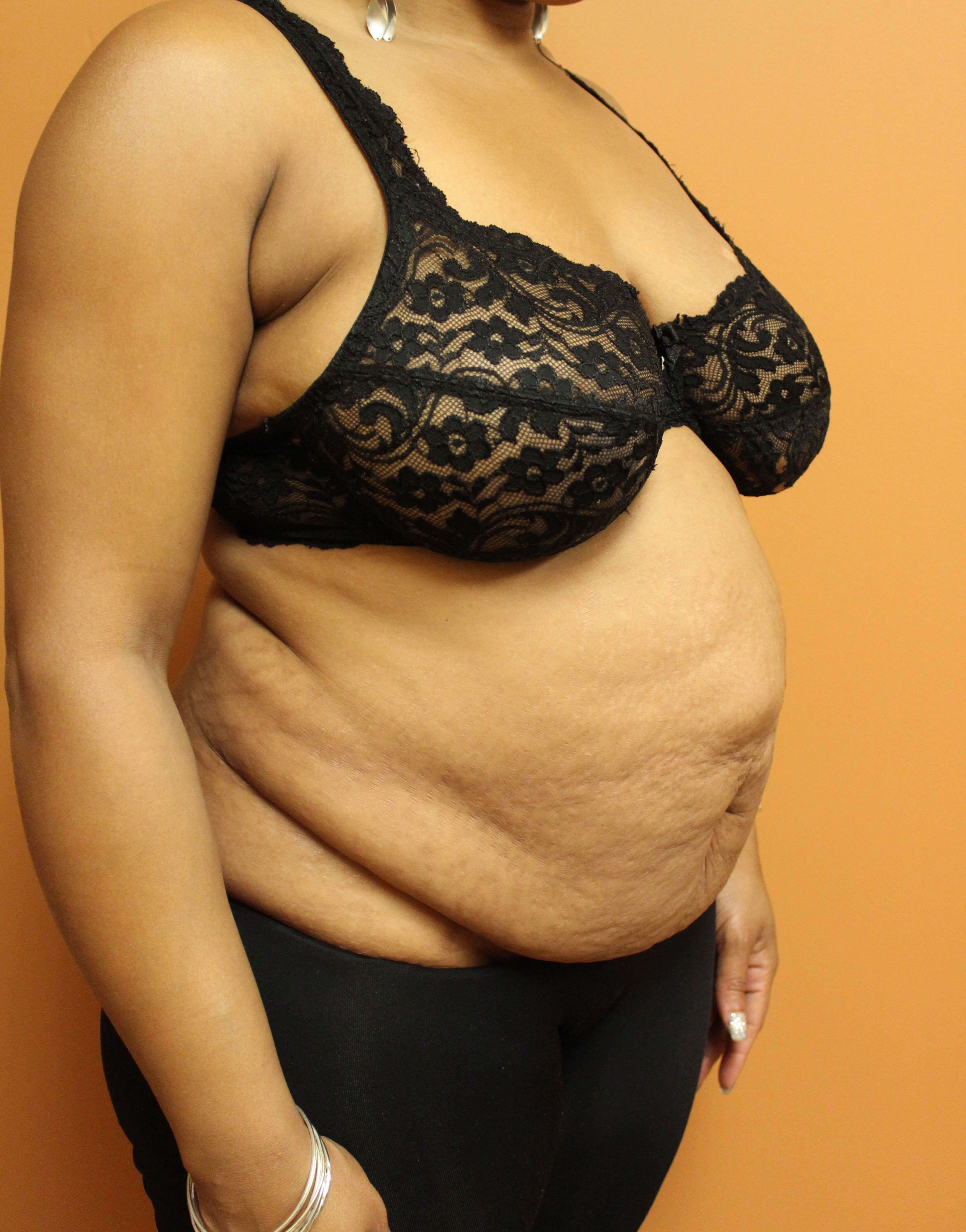 Tummy Tuck with Hernia Repair Before