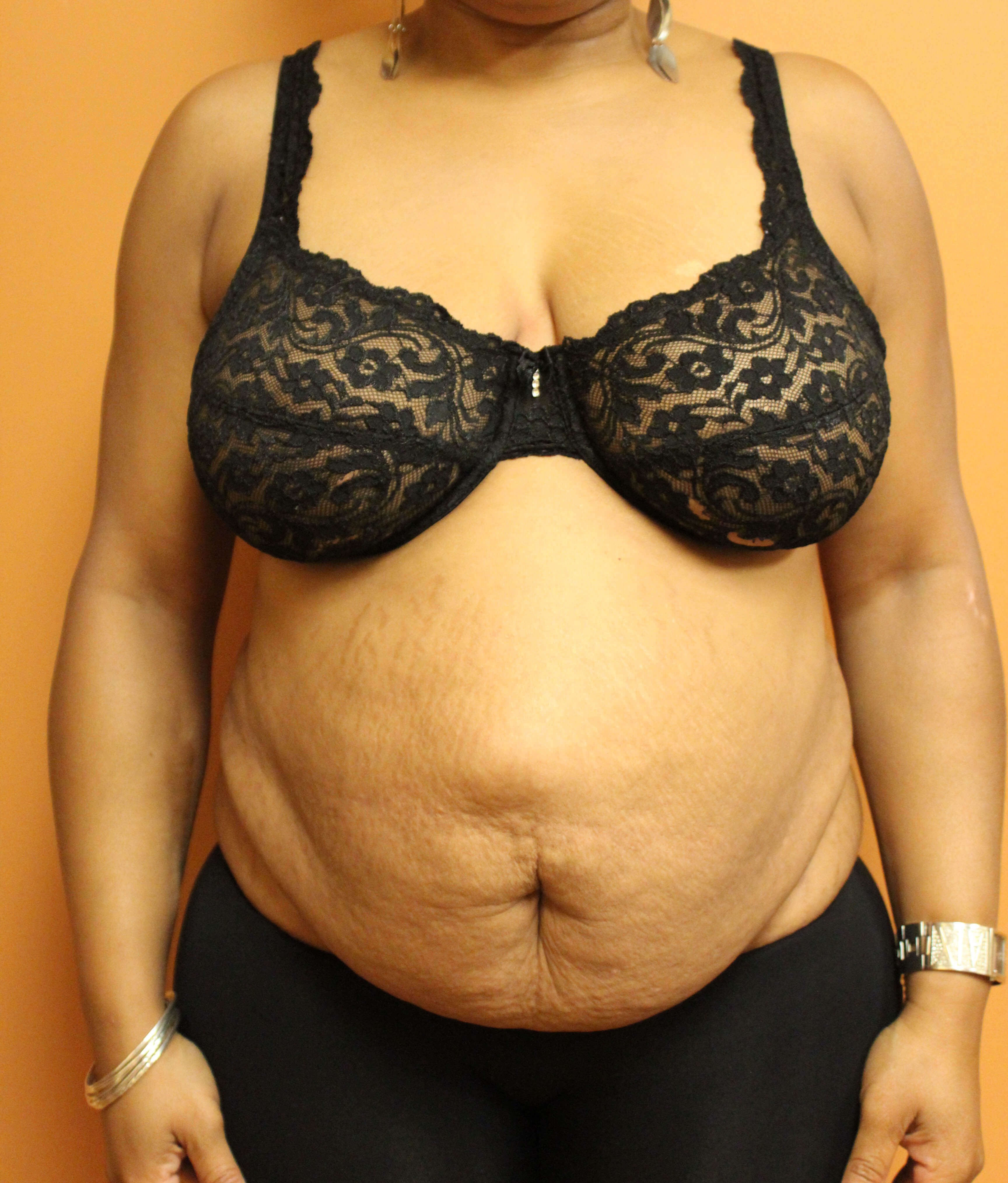 Tummy Tuck with Hernia Repair Before