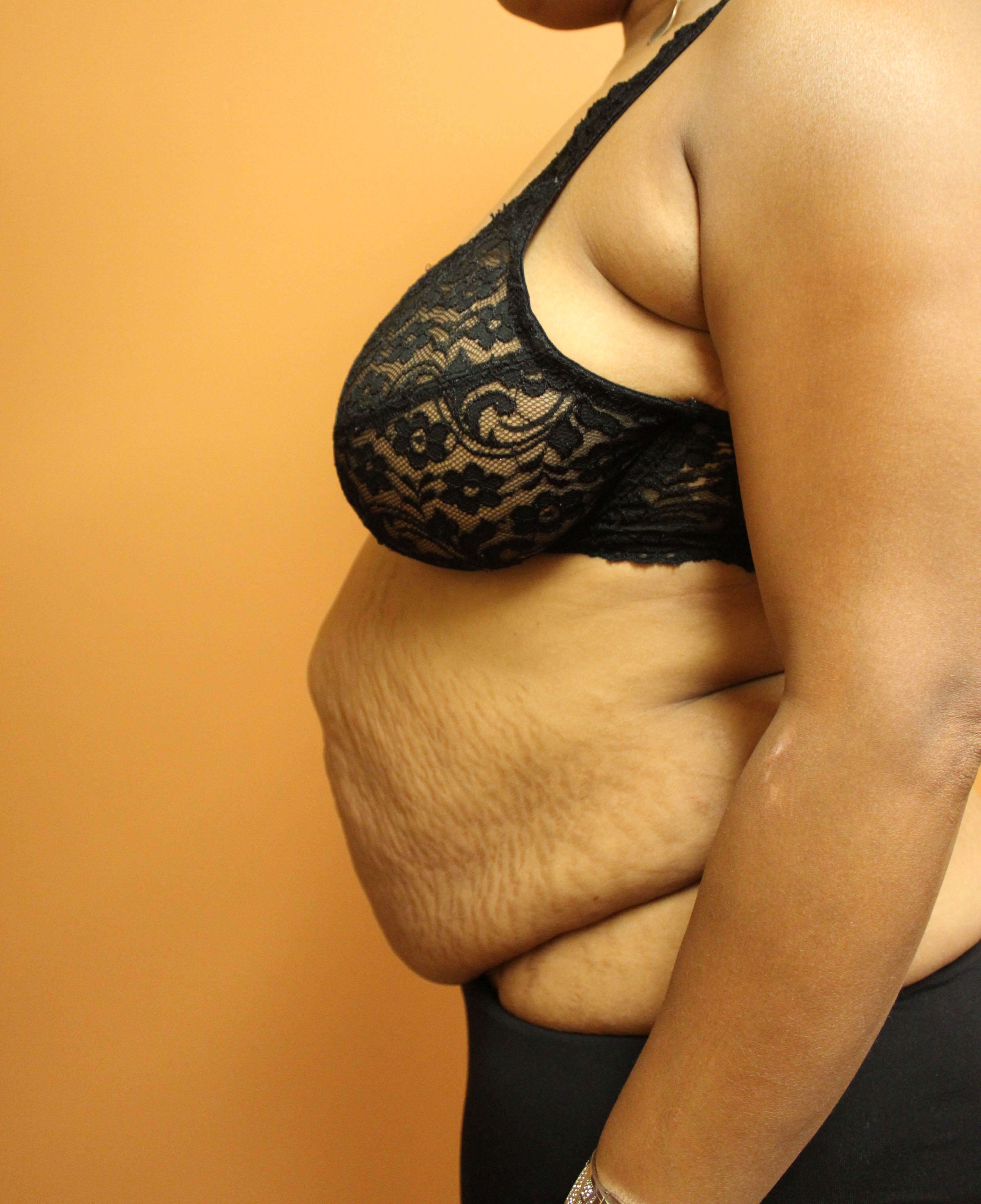 Tummy Tuck with Hernia Repair Before