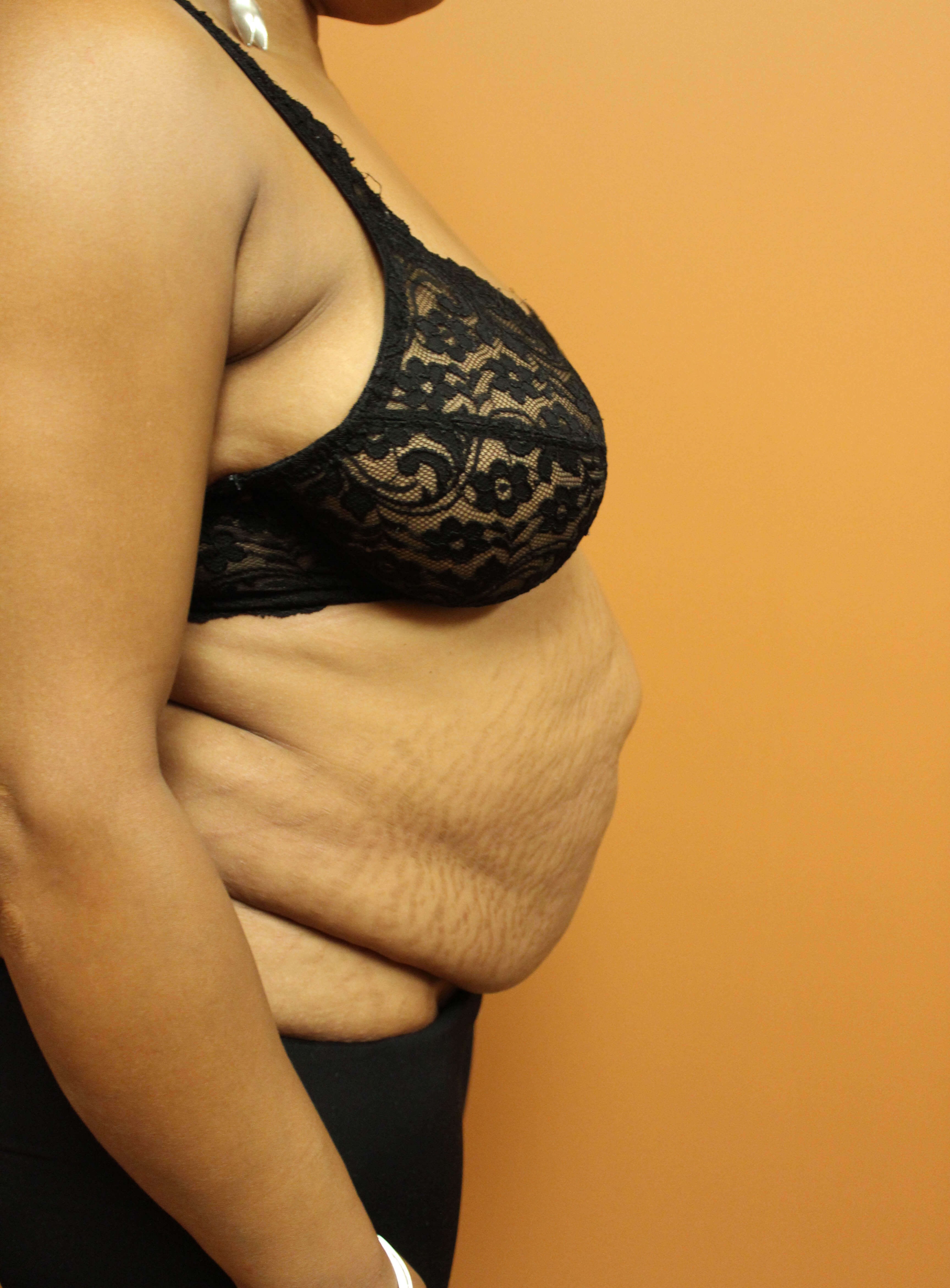 Tummy Tuck with Hernia Repair Before