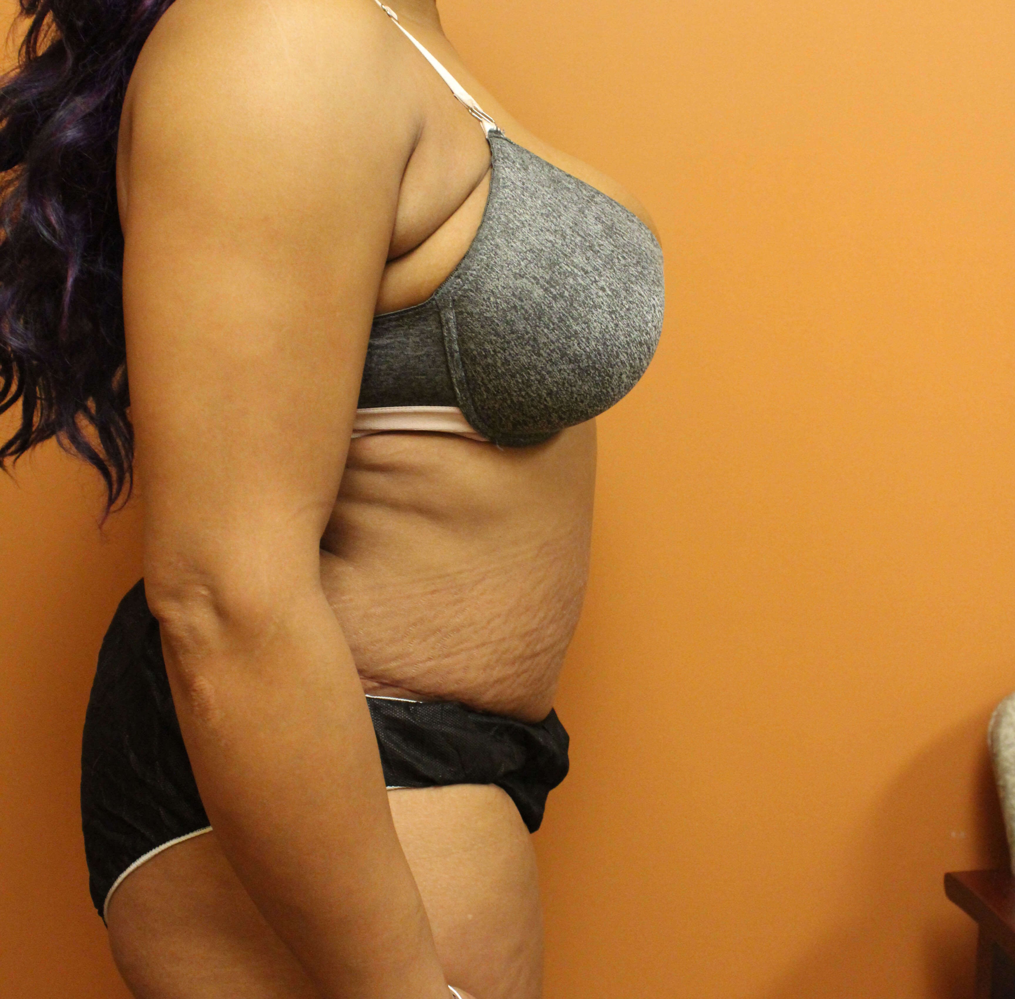 Tummy Tuck with Hernia Repair After