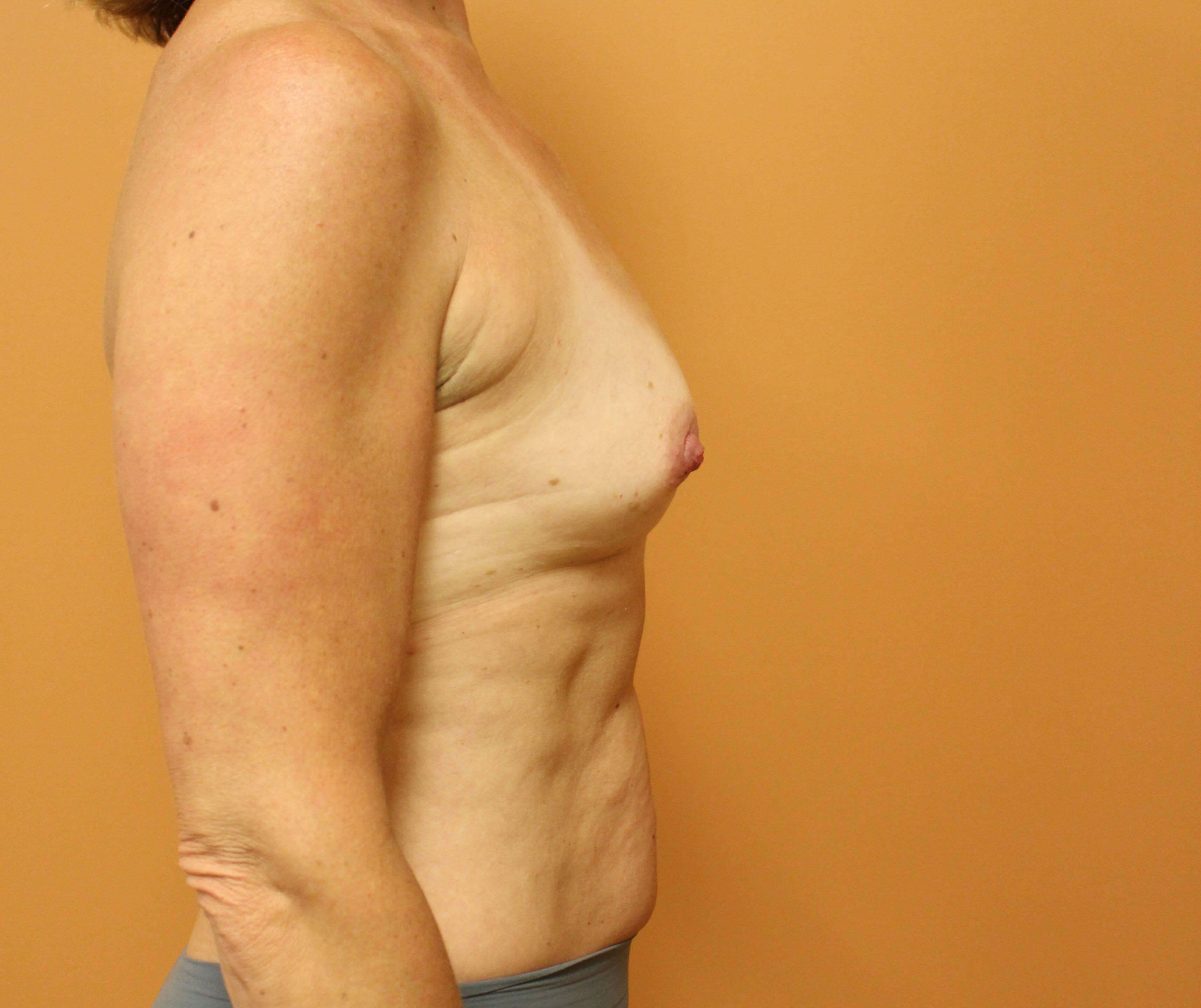 Nipple Sparing Reconstruction Before