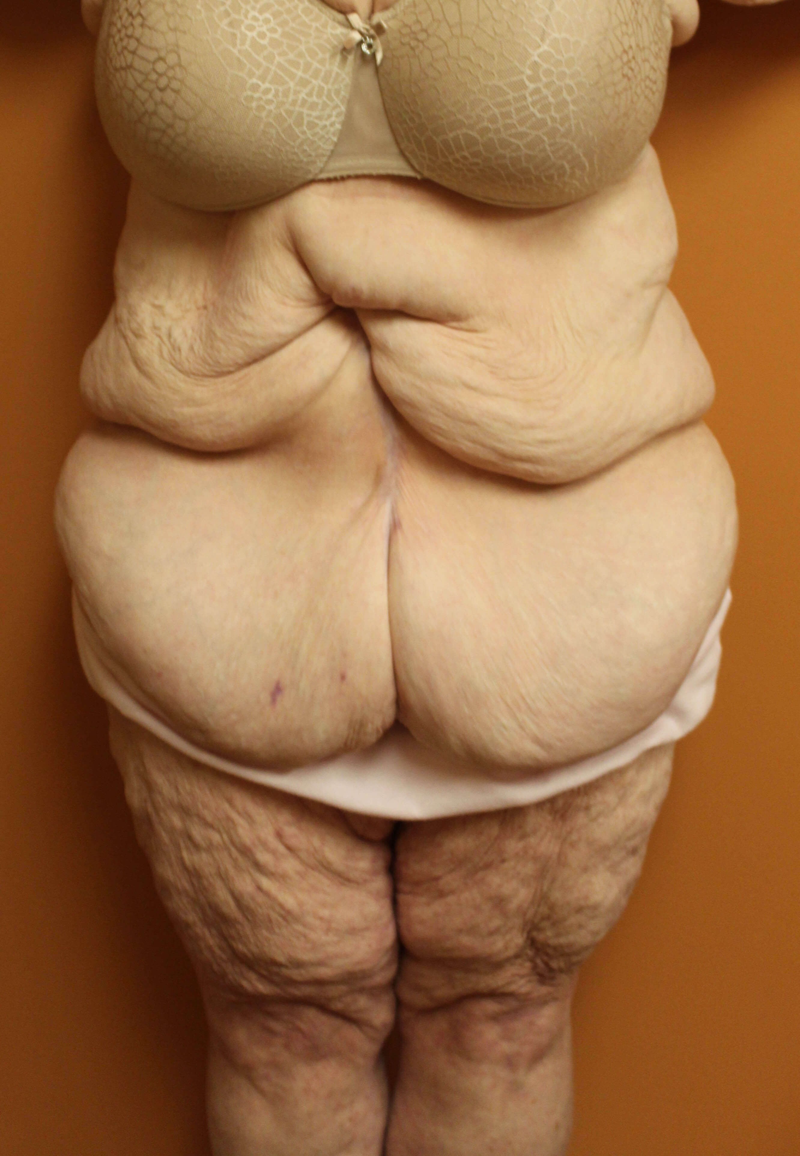 Fleur de lis Abdominoplasty Before