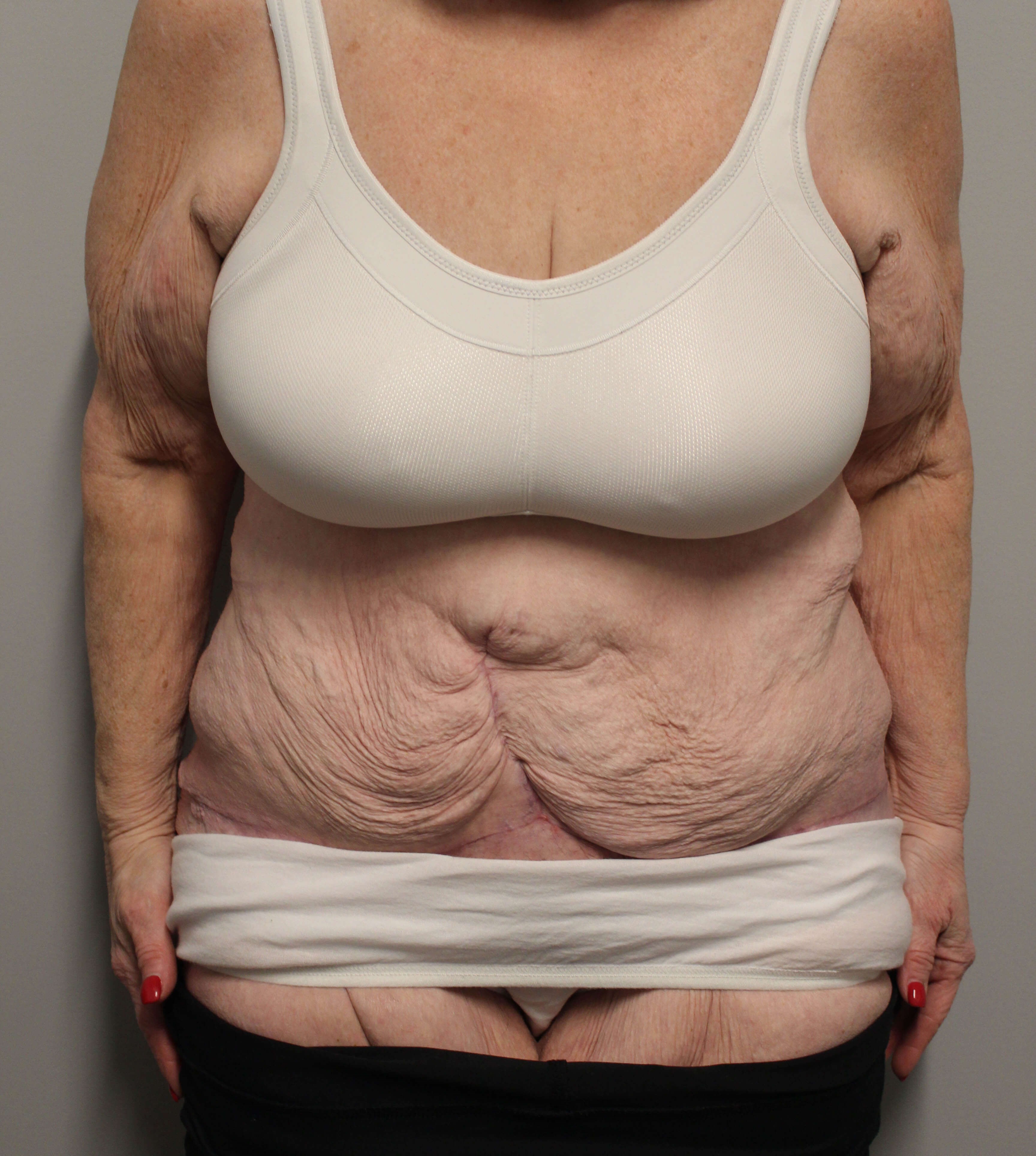 Fleur de lis Abdominoplasty After