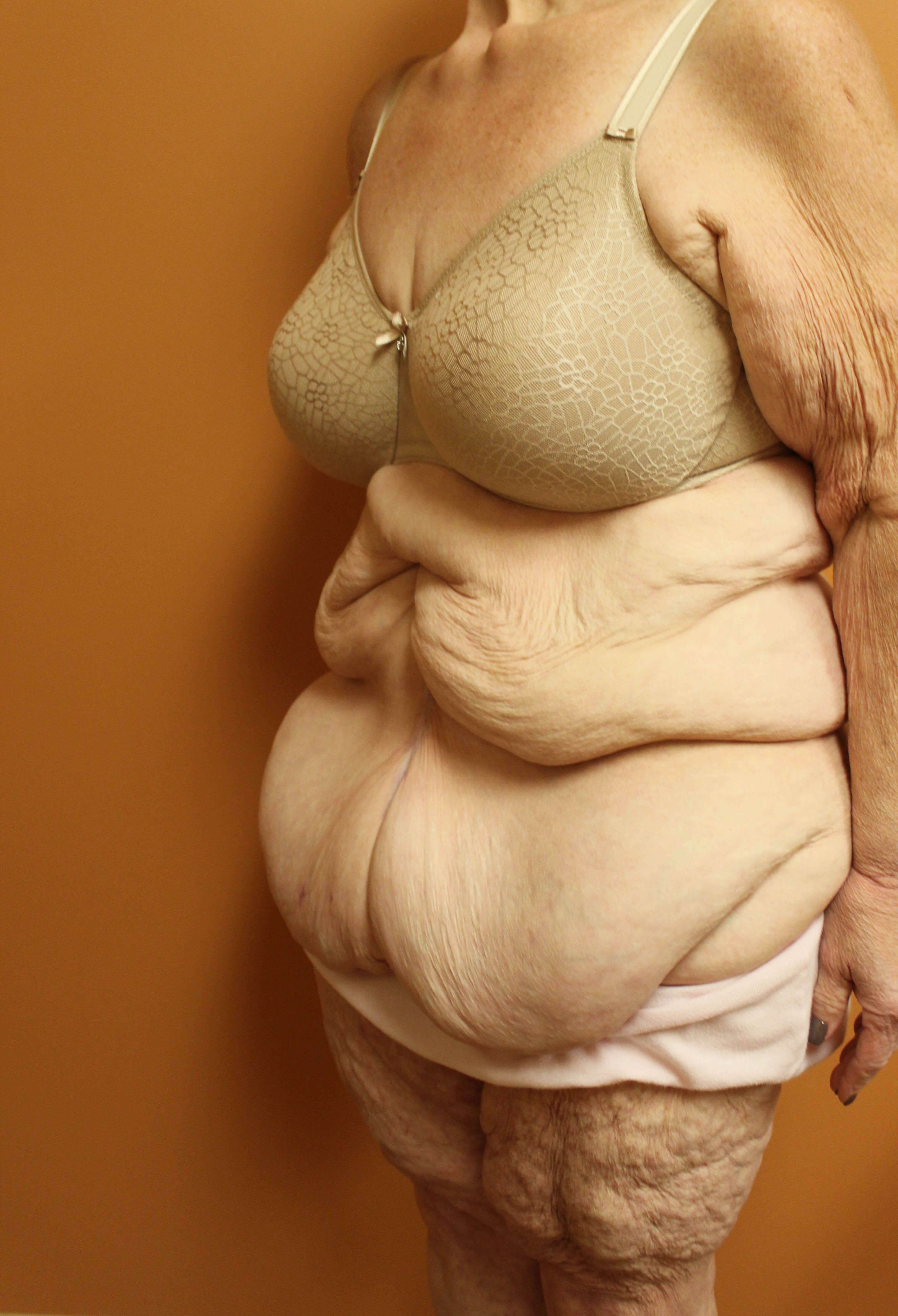 Fleur de lis Abdominoplasty Before