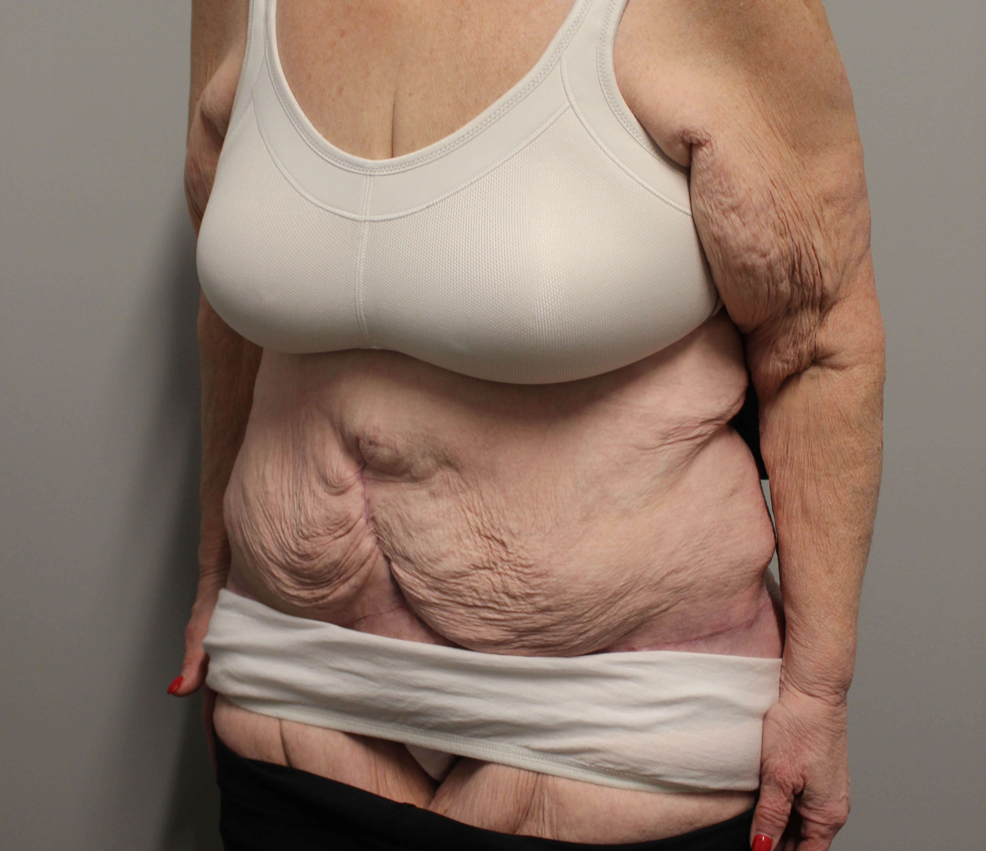 Fleur de lis Abdominoplasty After