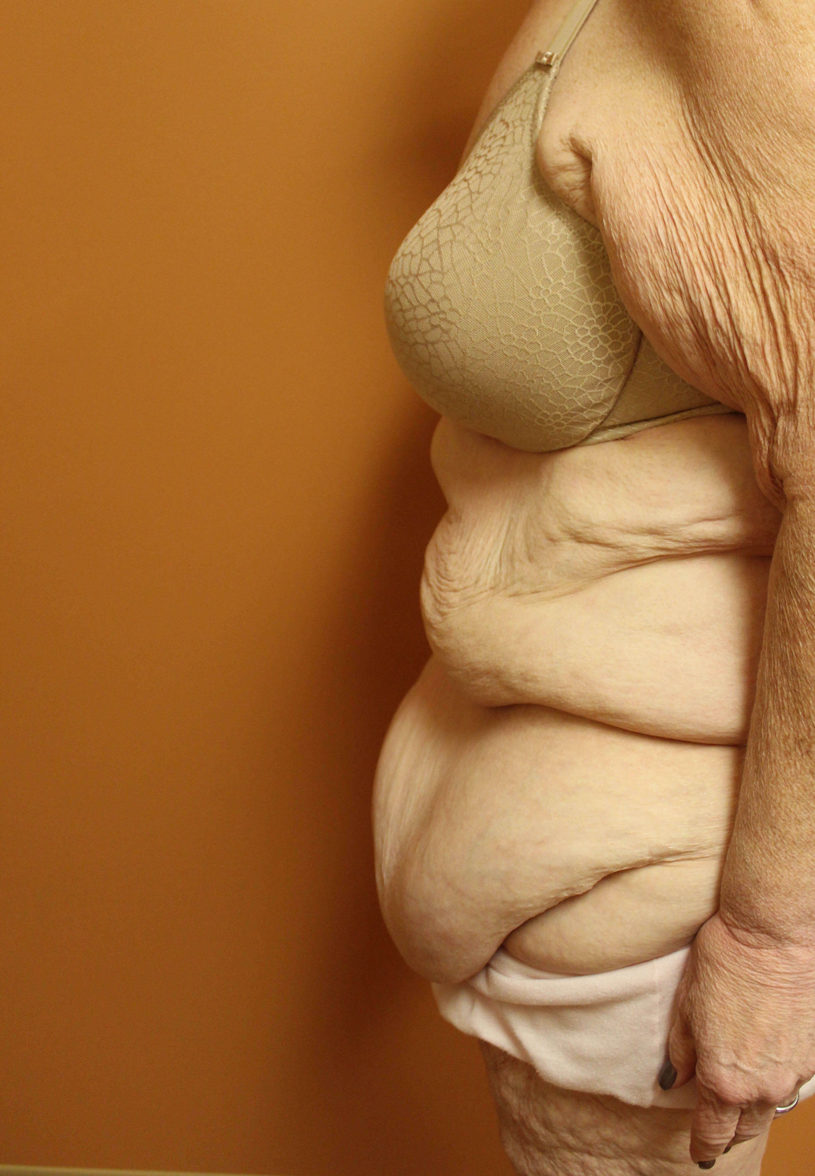 Fleur de lis Abdominoplasty Before