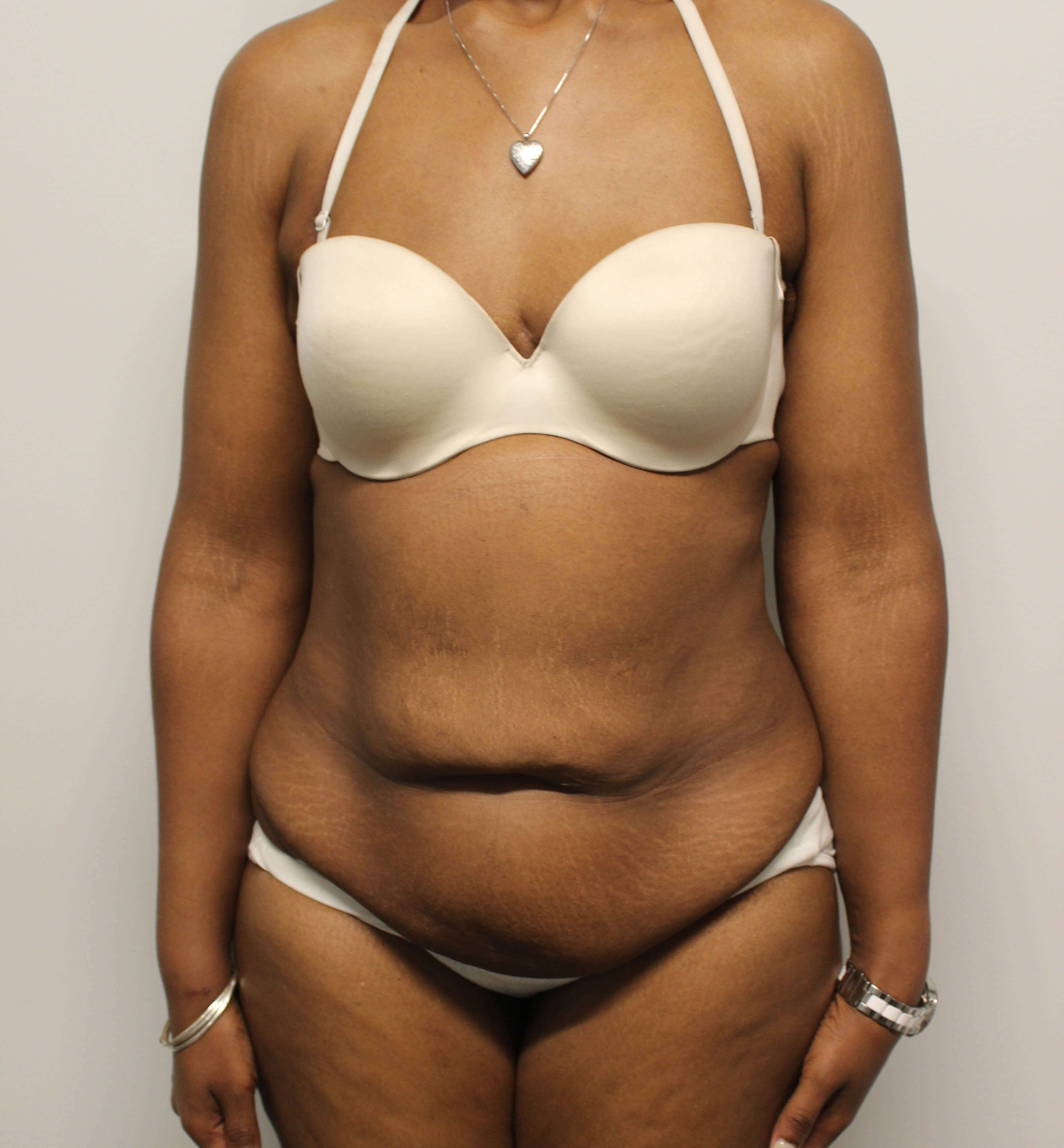 Tummy Tuck after weight loss Before