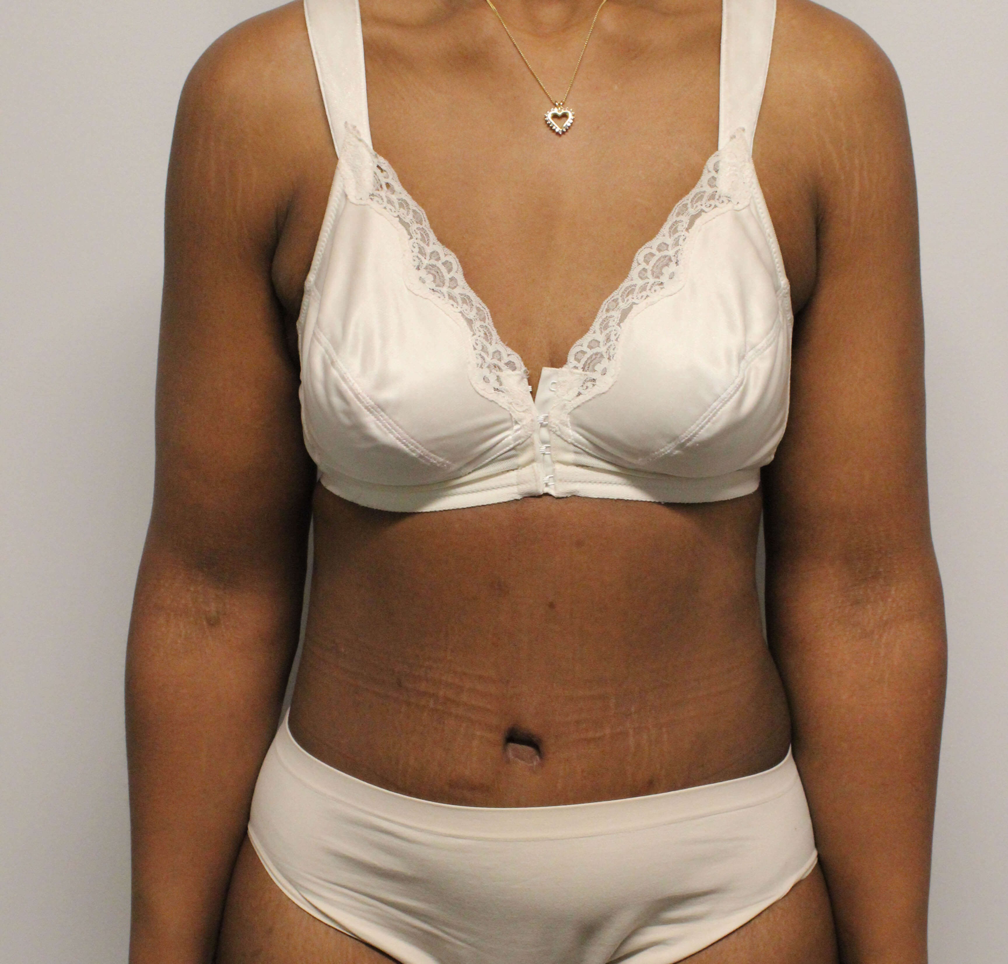 Tummy Tuck after weight loss After