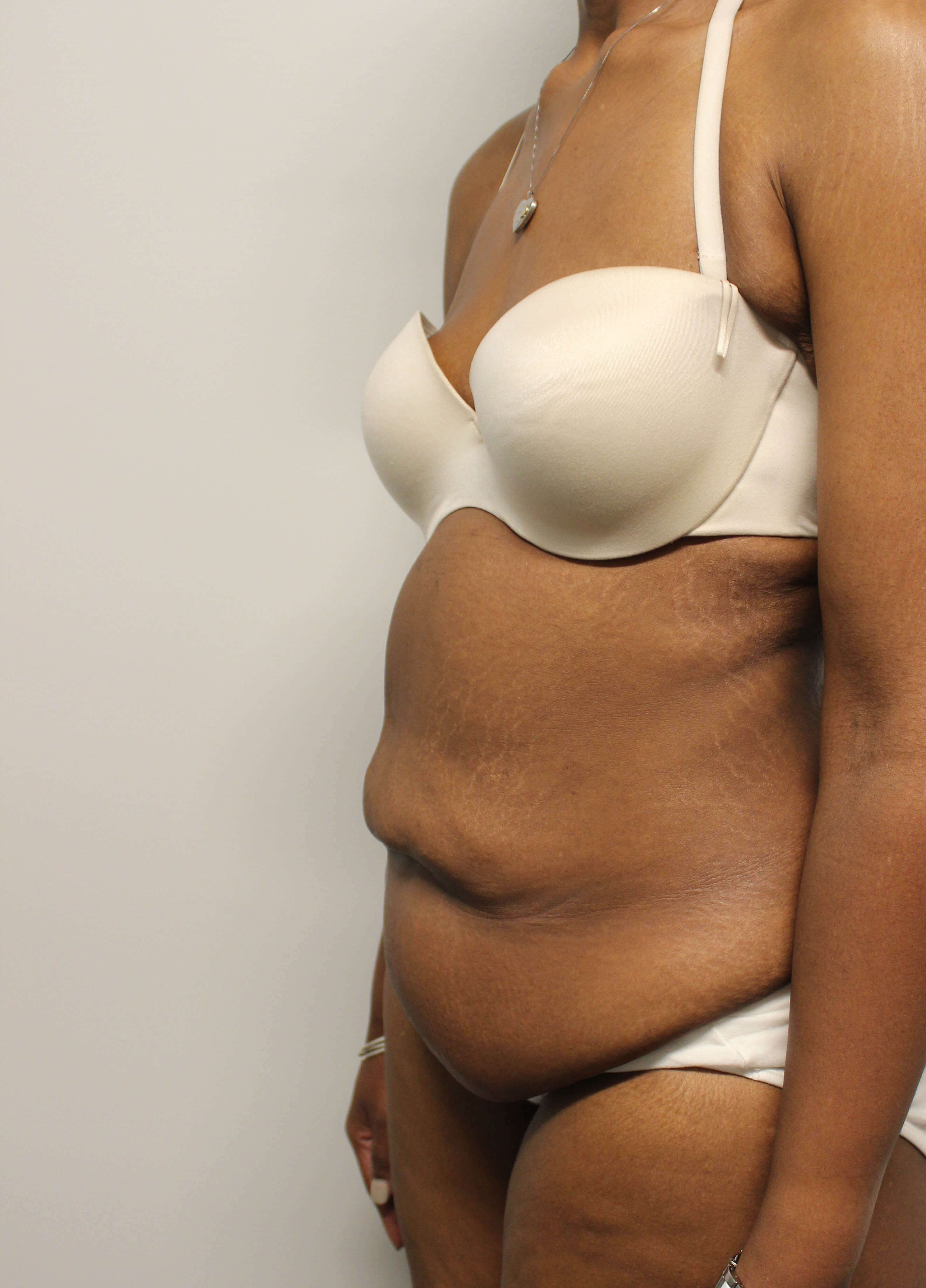 Tummy Tuck after weight loss Before