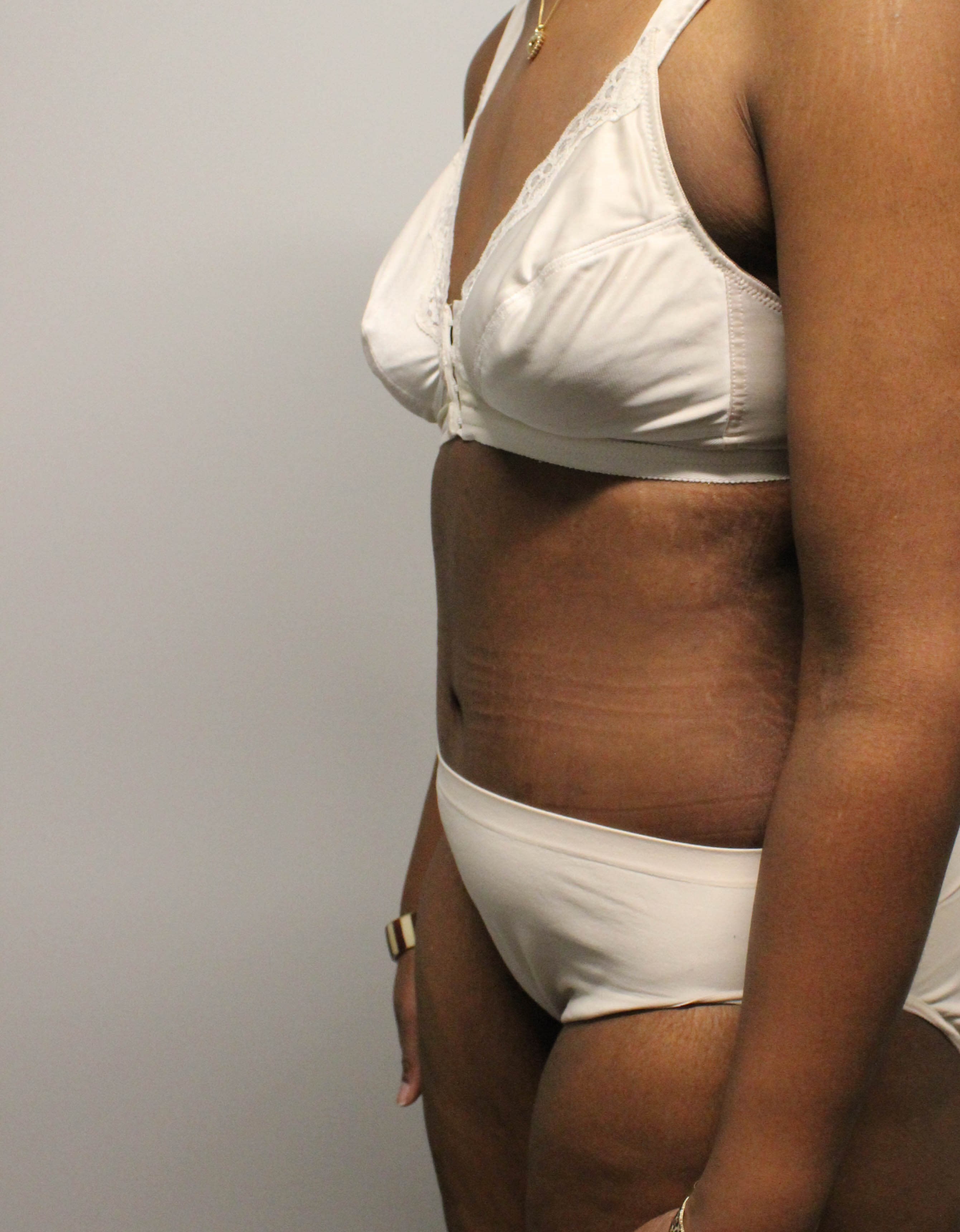 Tummy Tuck after weight loss After