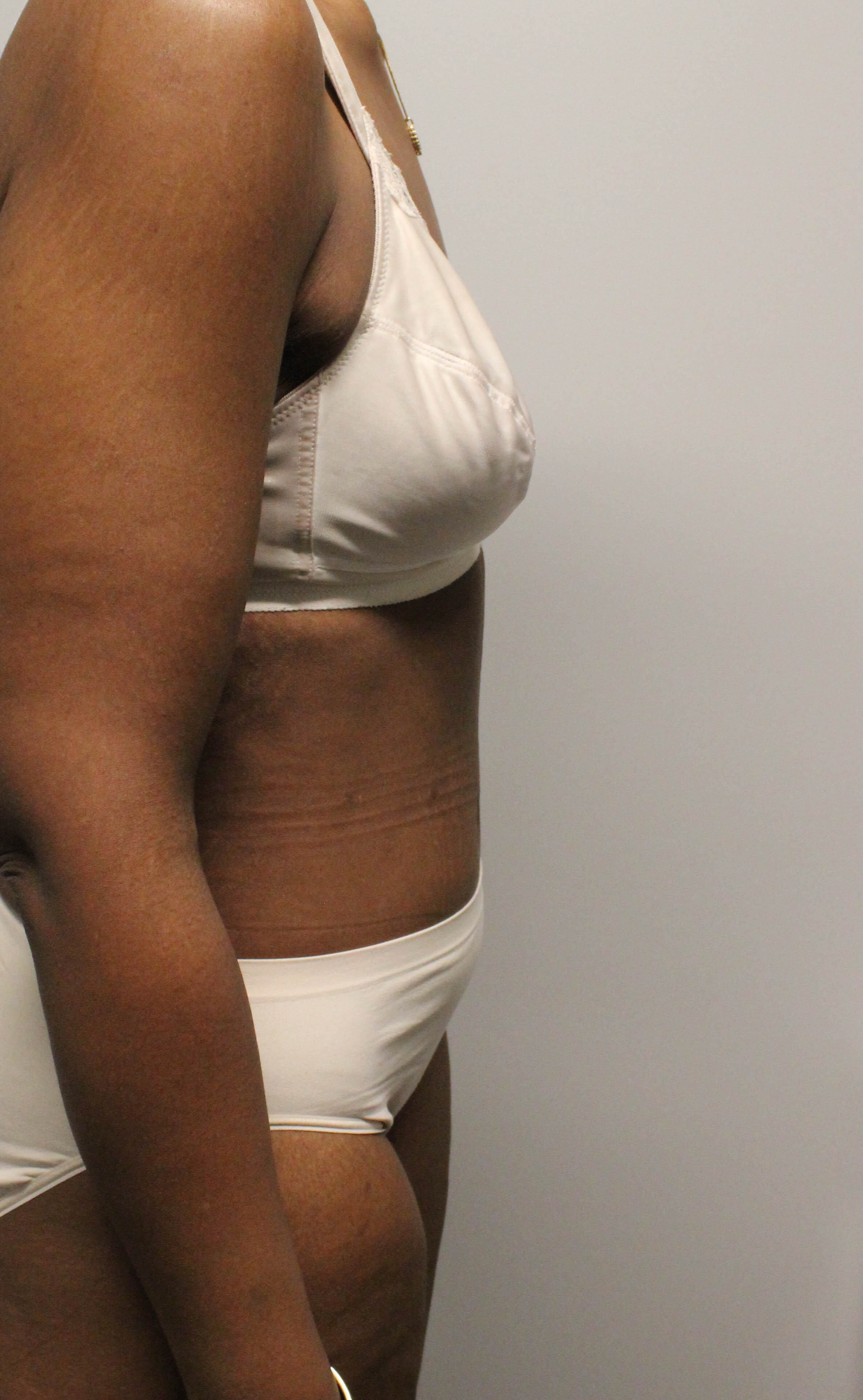 Tummy Tuck after weight loss After