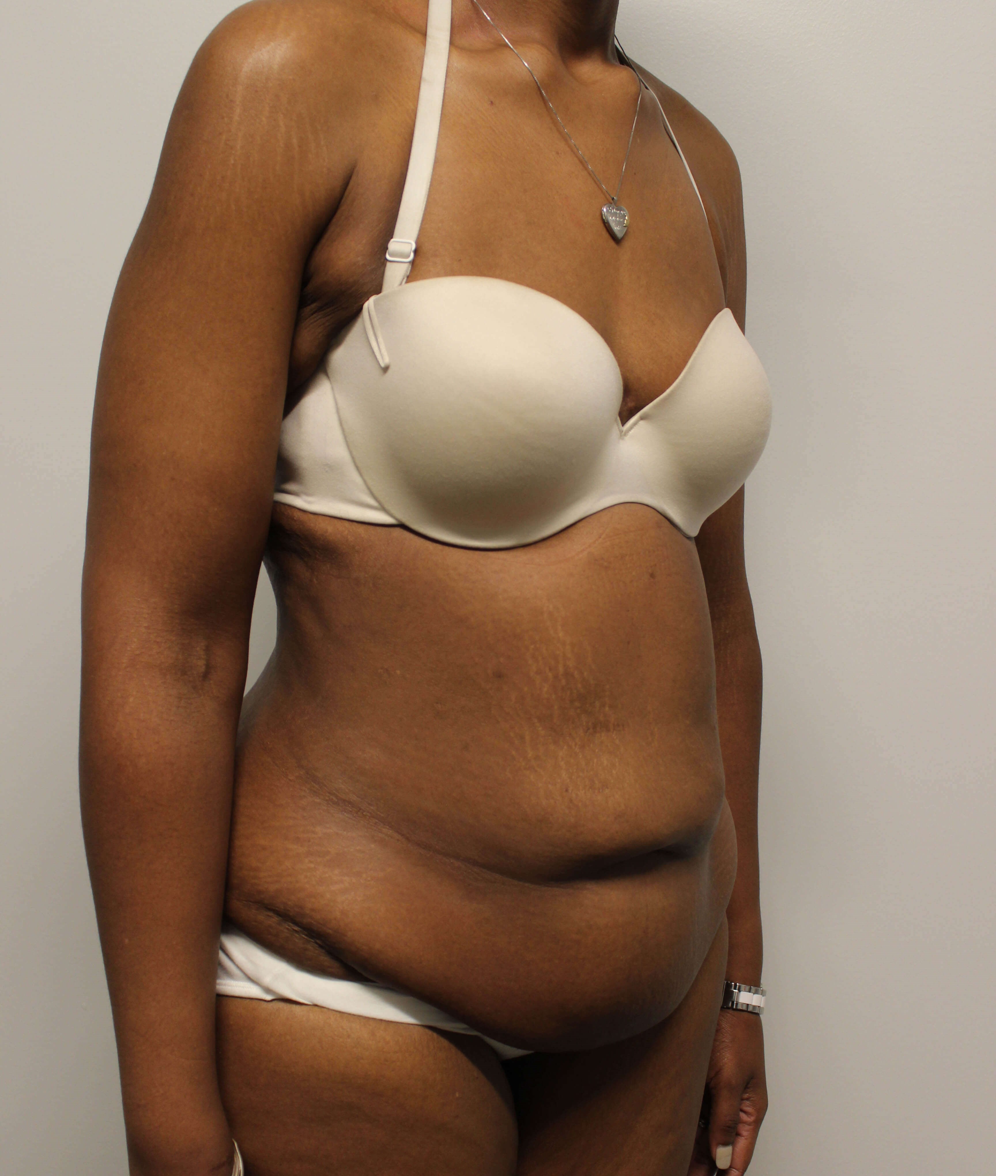 Tummy Tuck after weight loss Before