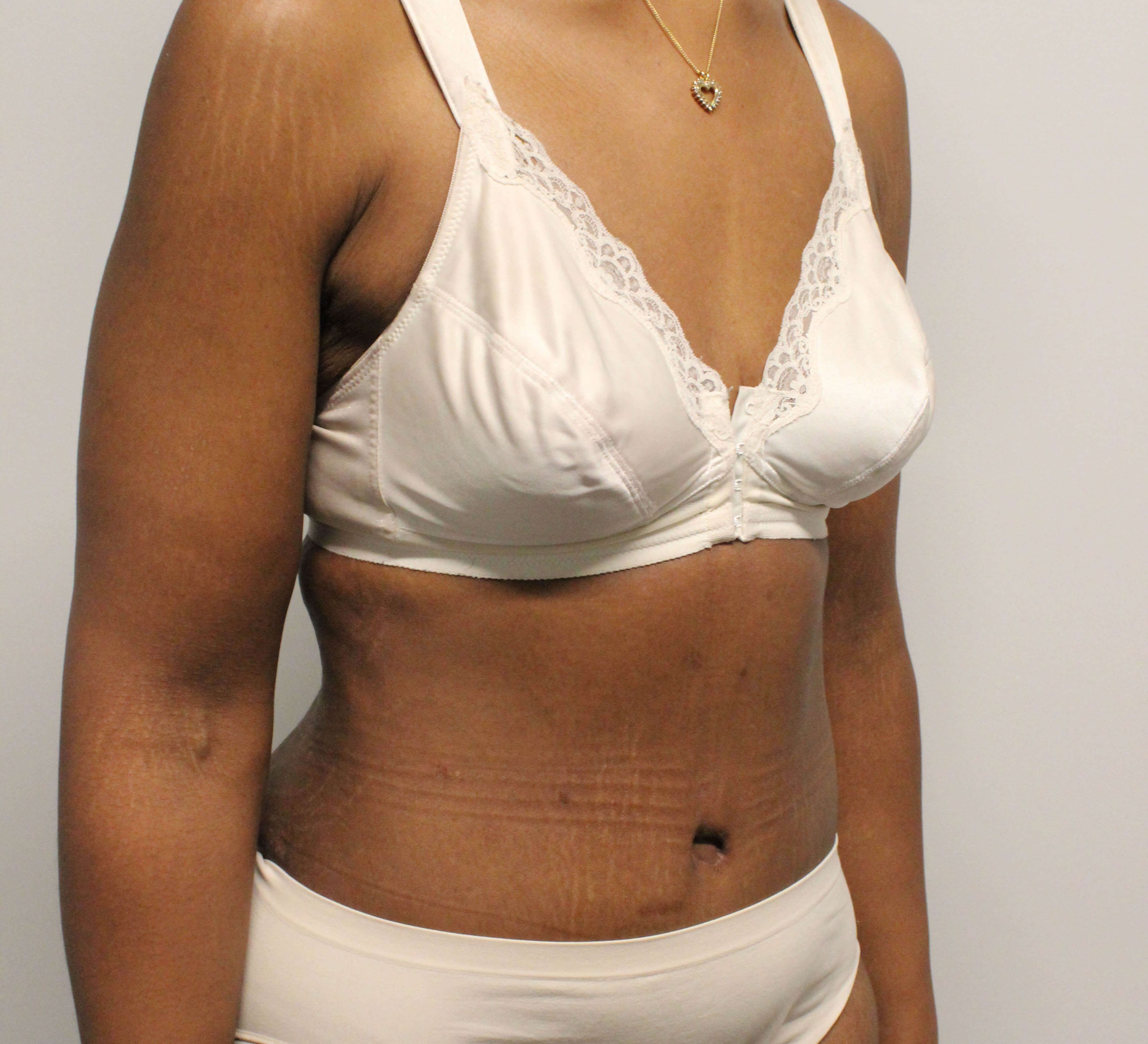 Tummy Tuck after weight loss After