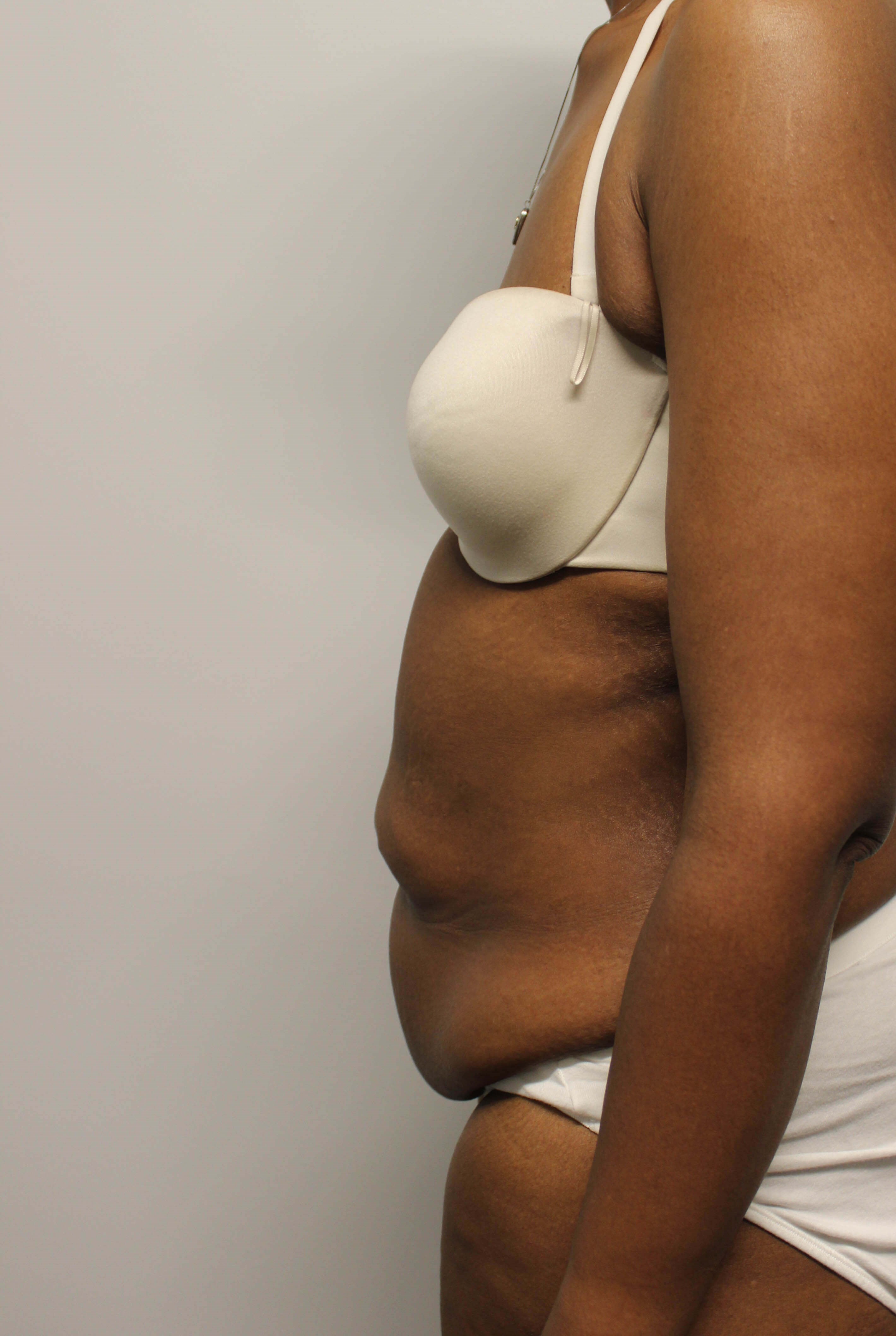 Tummy Tuck after weight loss Before