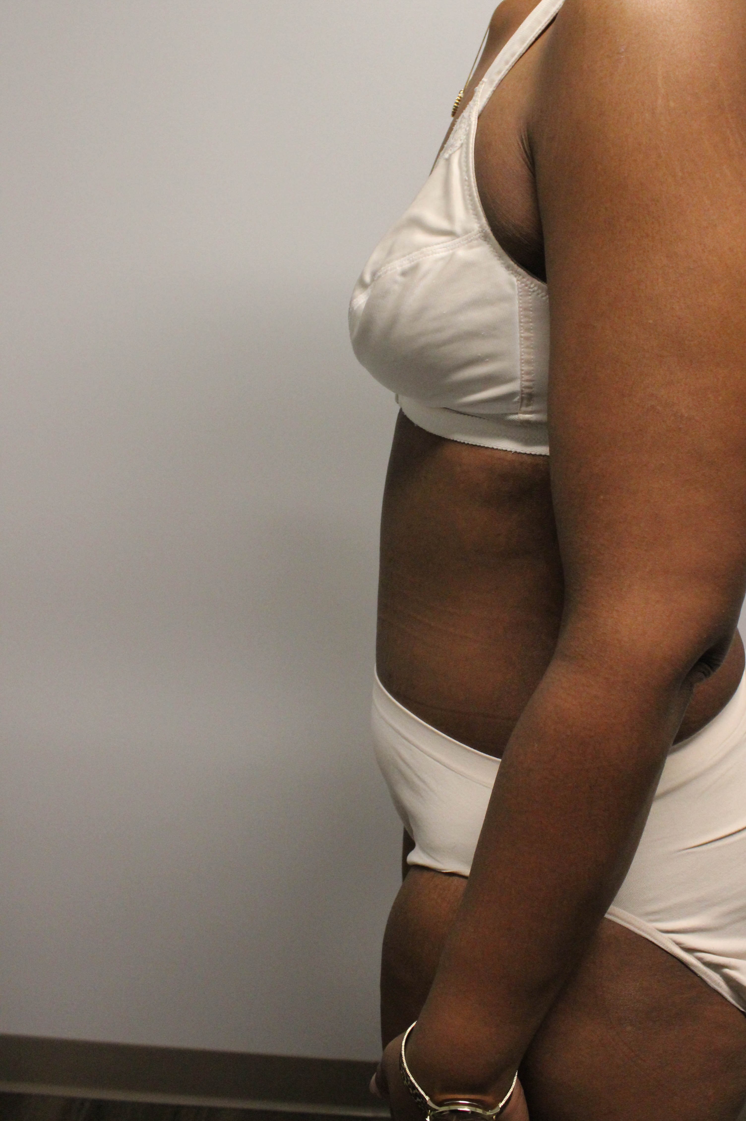 Tummy Tuck after weight loss After