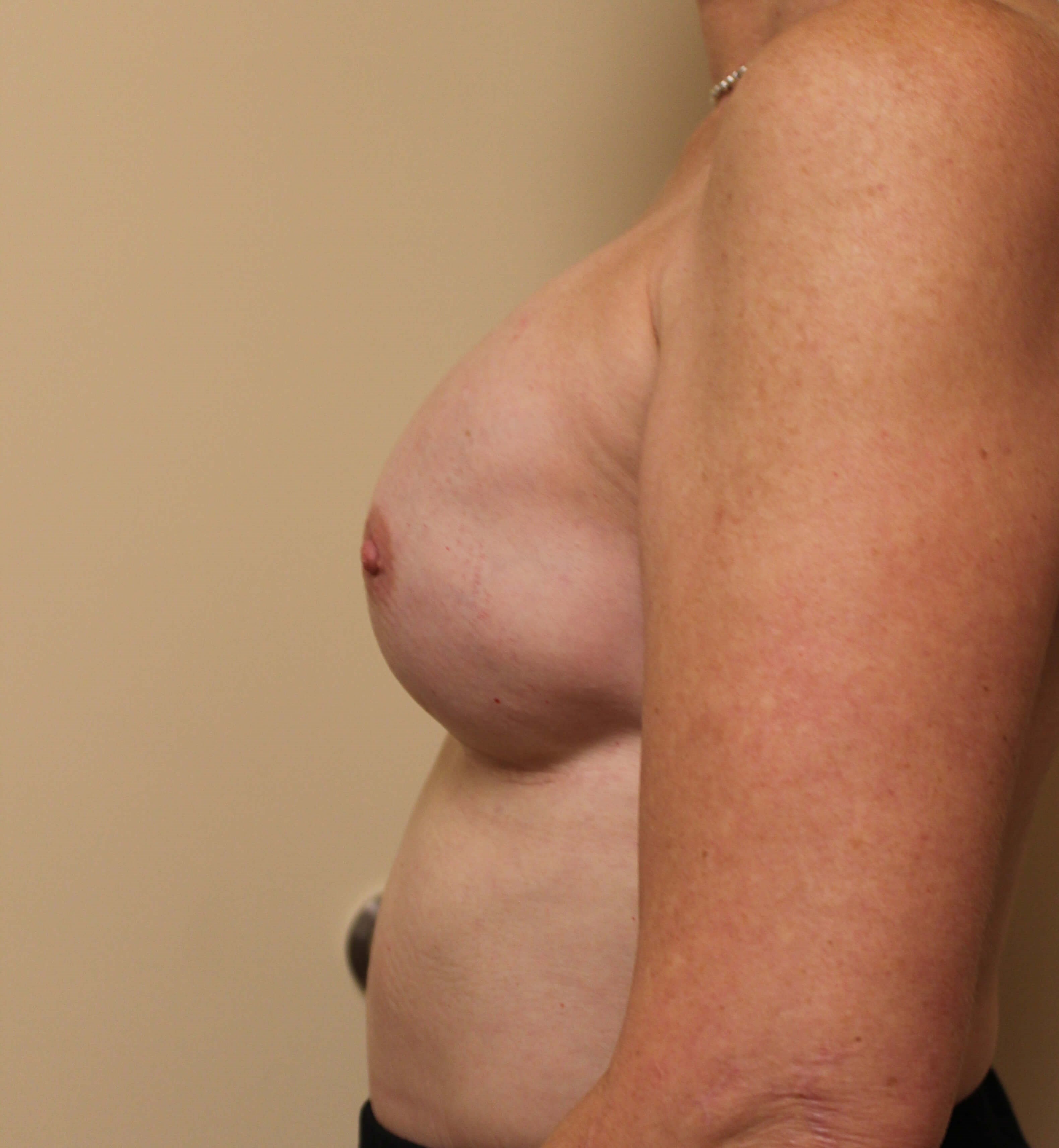 Fat Transfer to Breasts Before