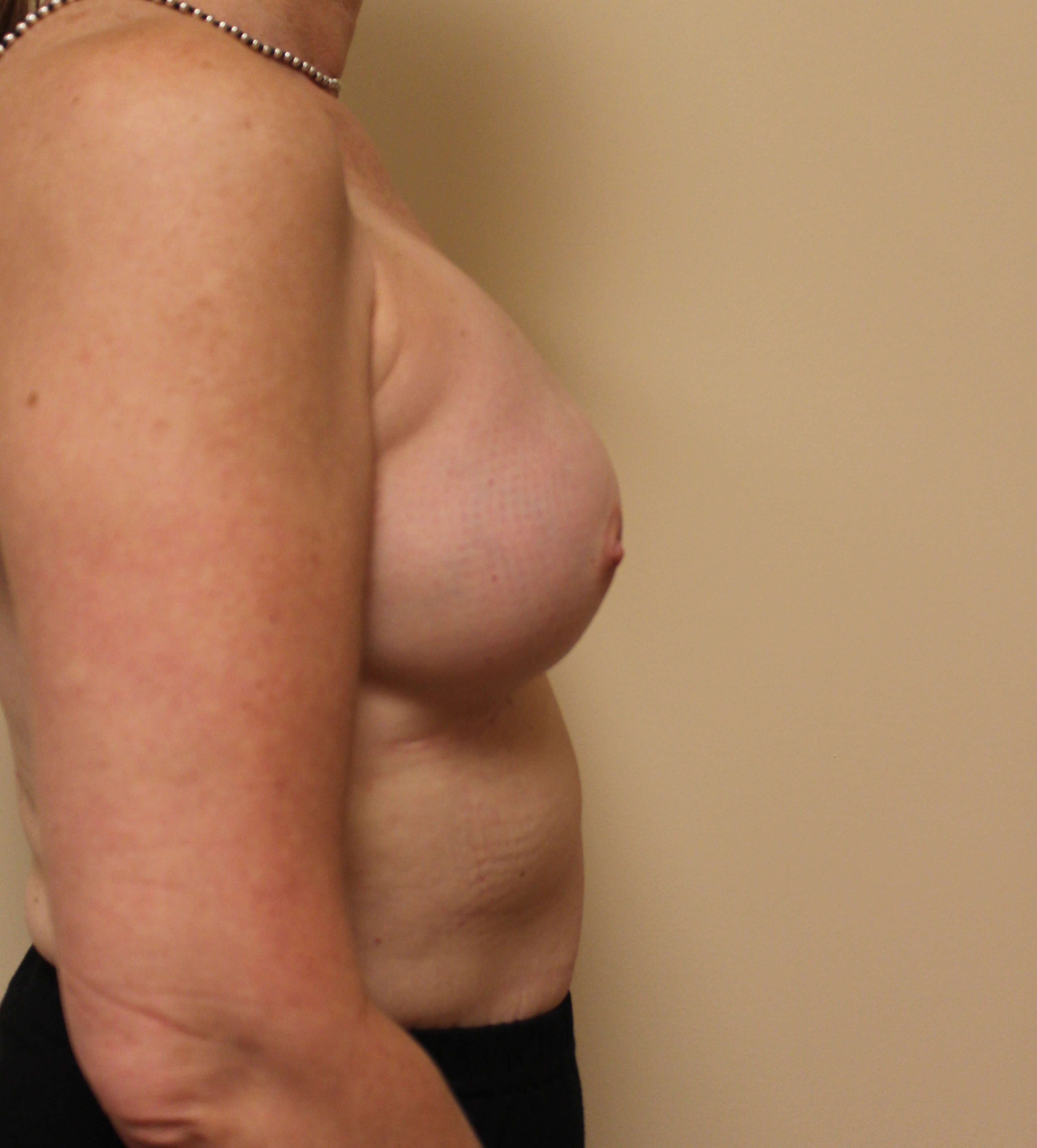 Fat Transfer to Breasts Before