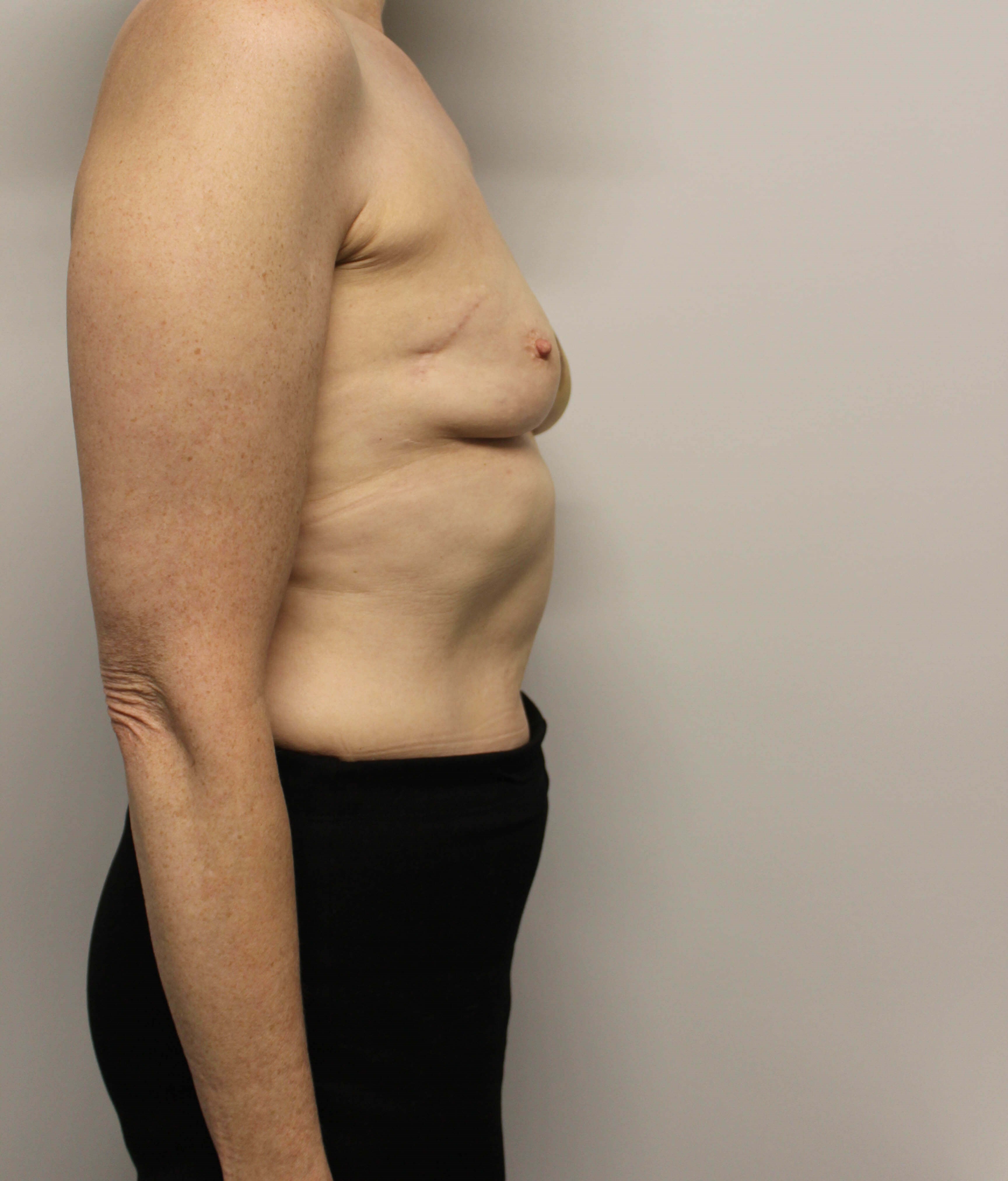 Tissue Expander to Implant Before