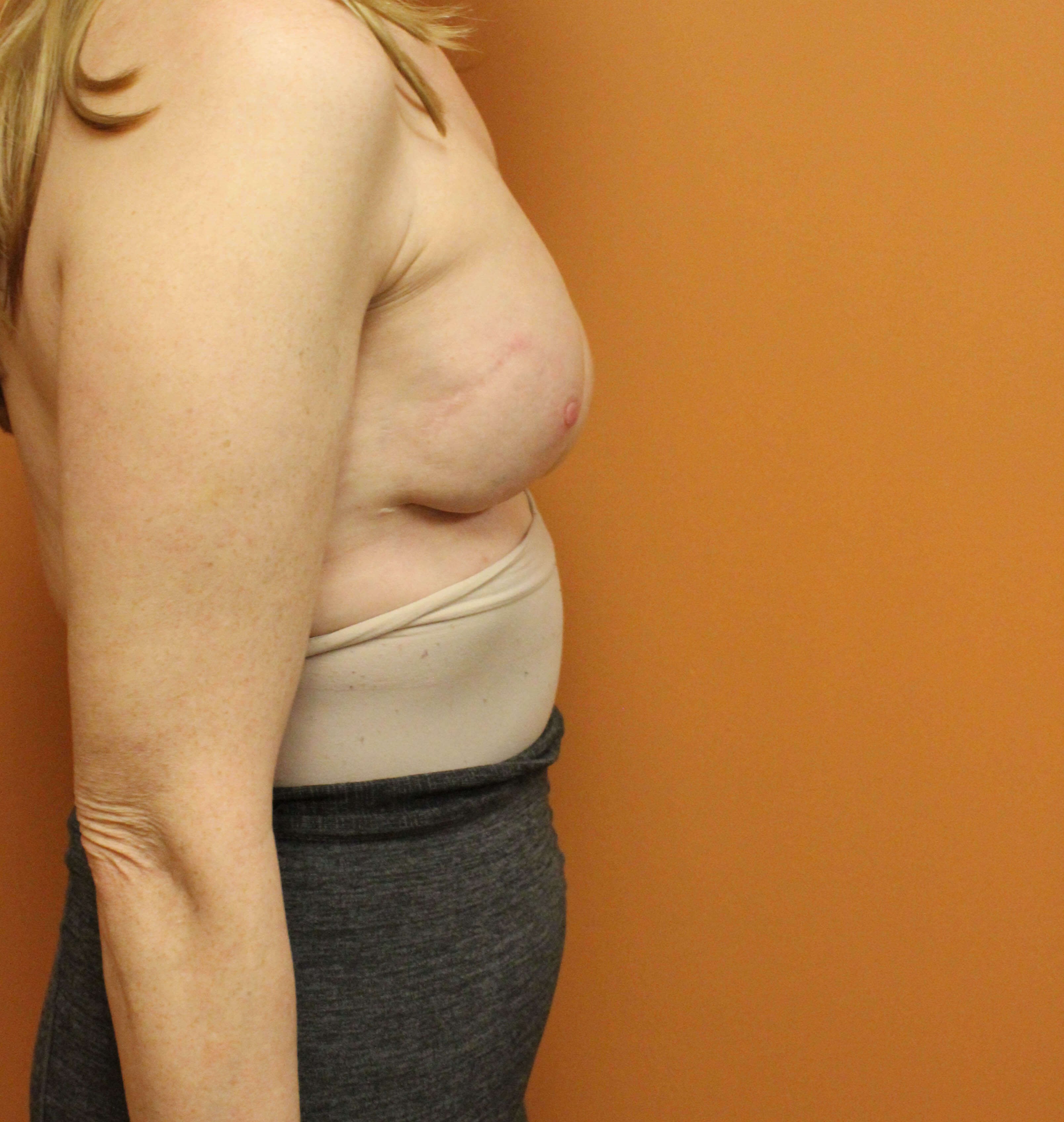 Tissue Expander to Implant After