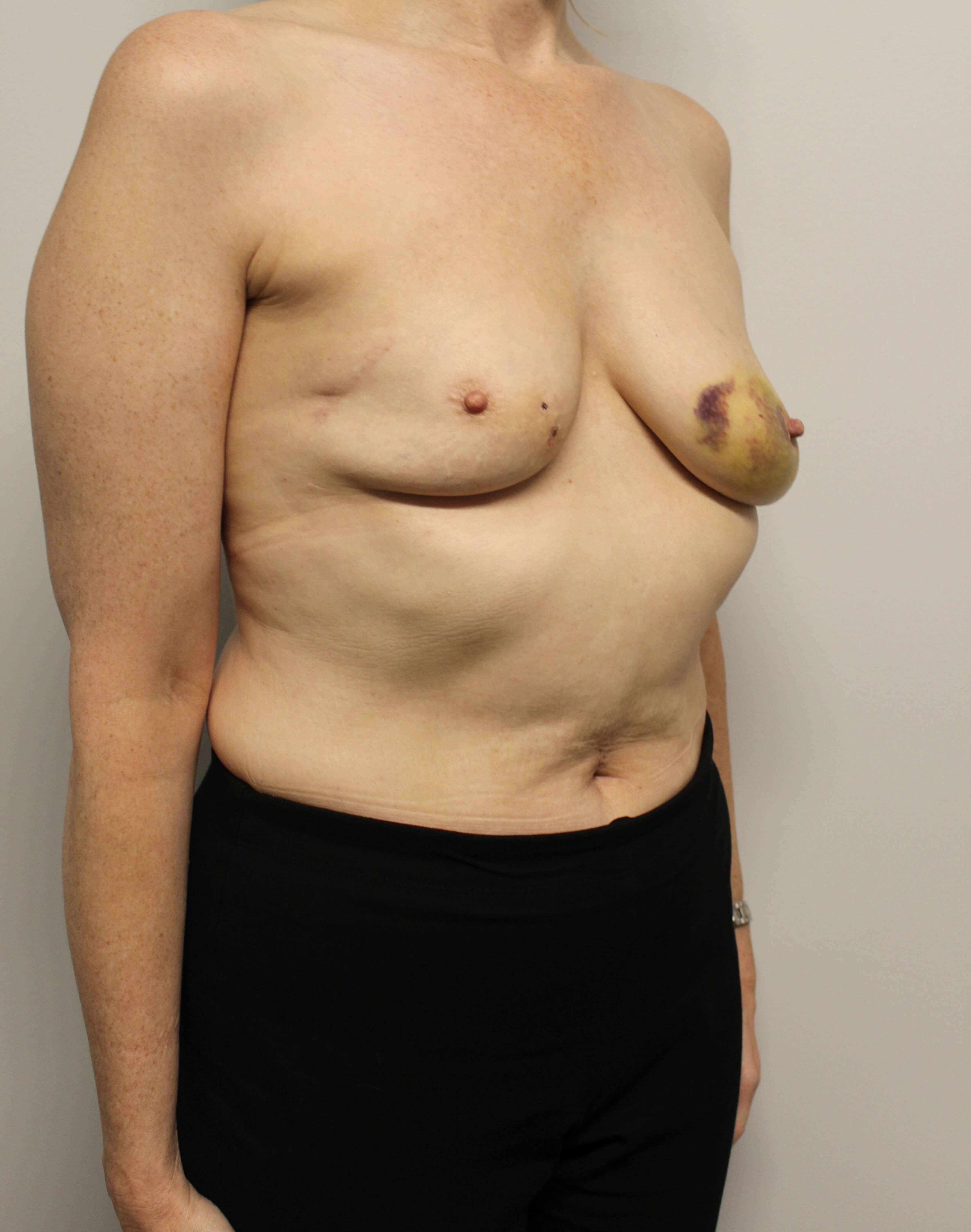 Tissue Expander to Implant Before