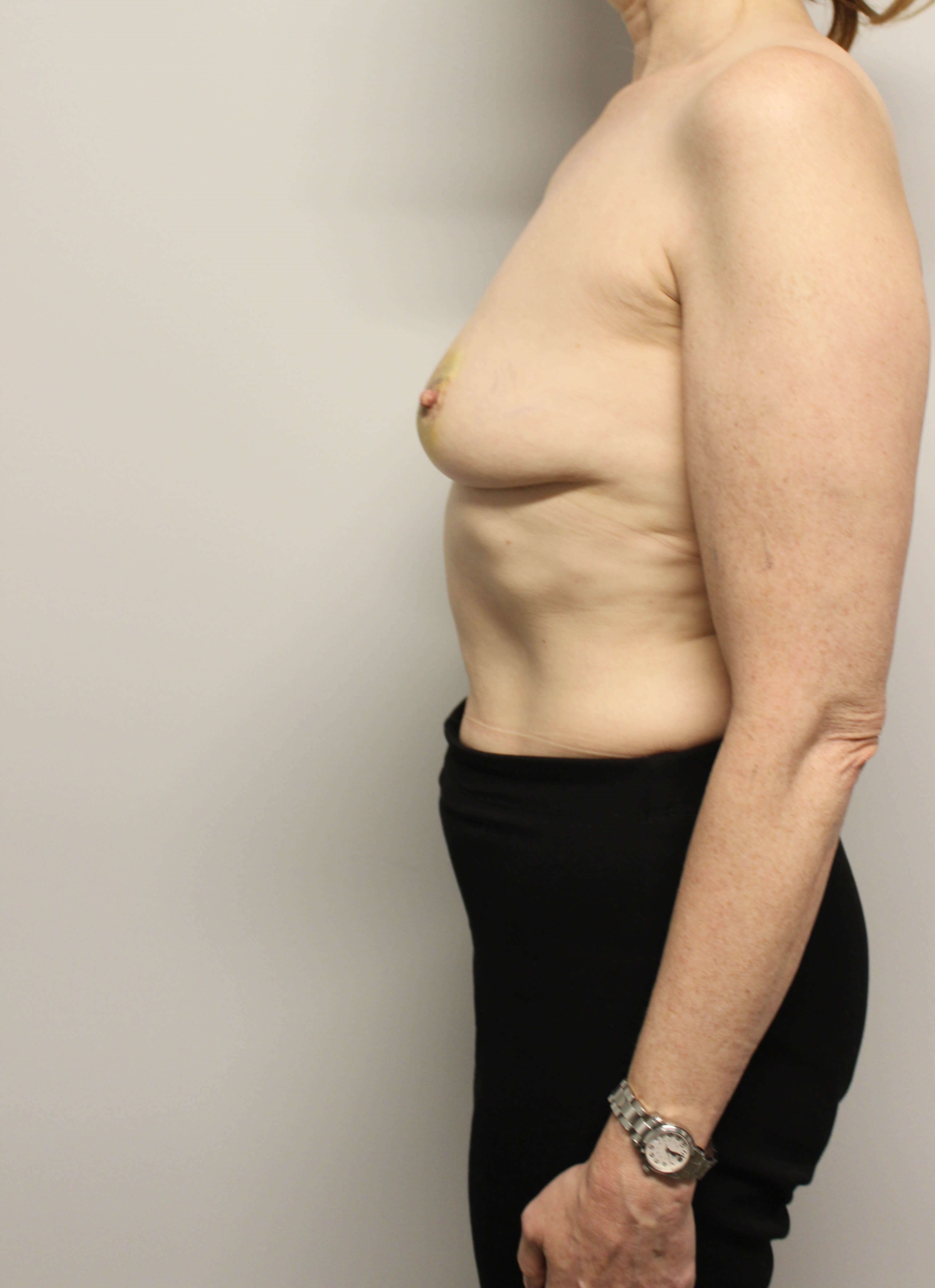 Tissue Expander to Implant Before