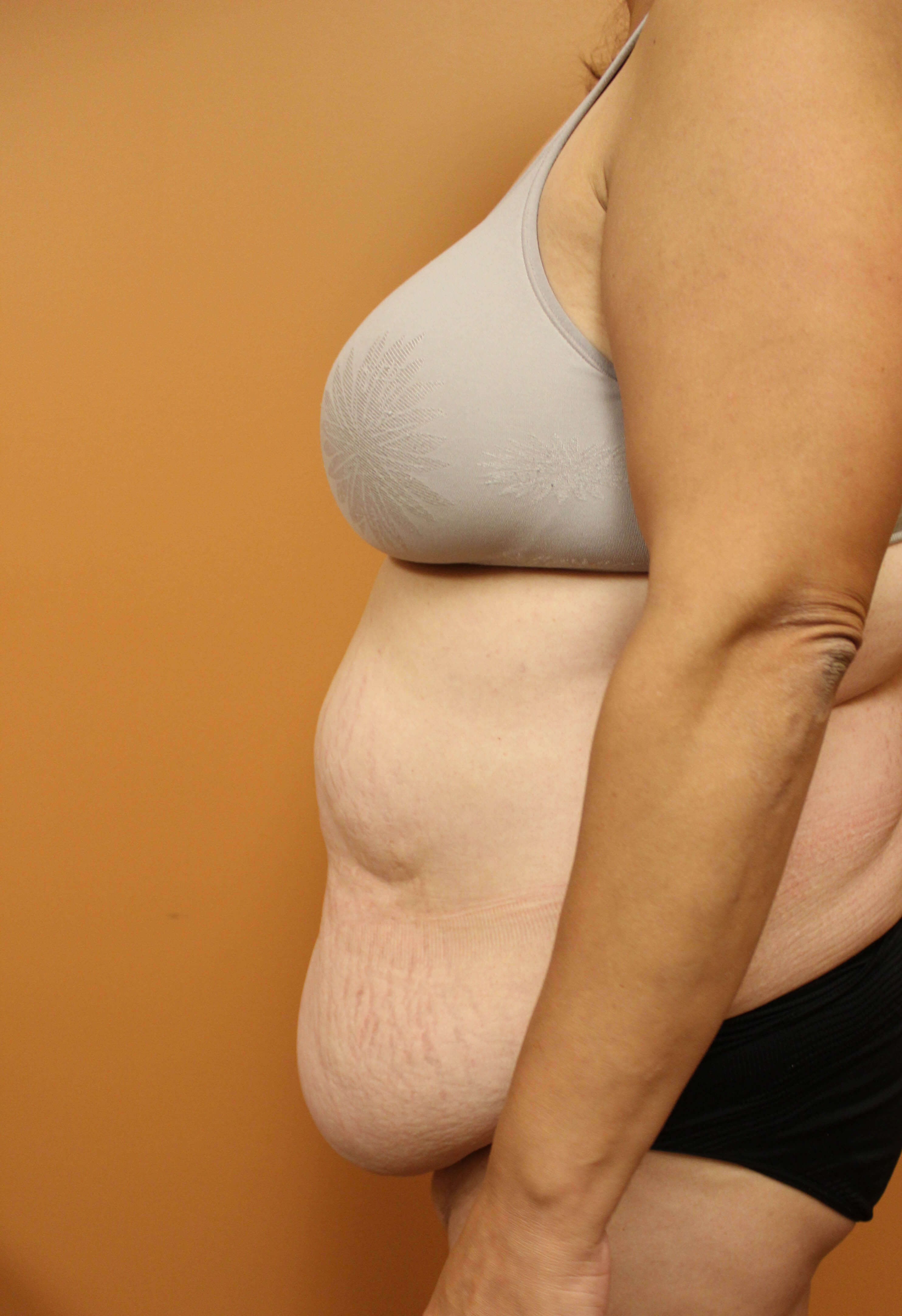 Tummy Tuck Surgery Before