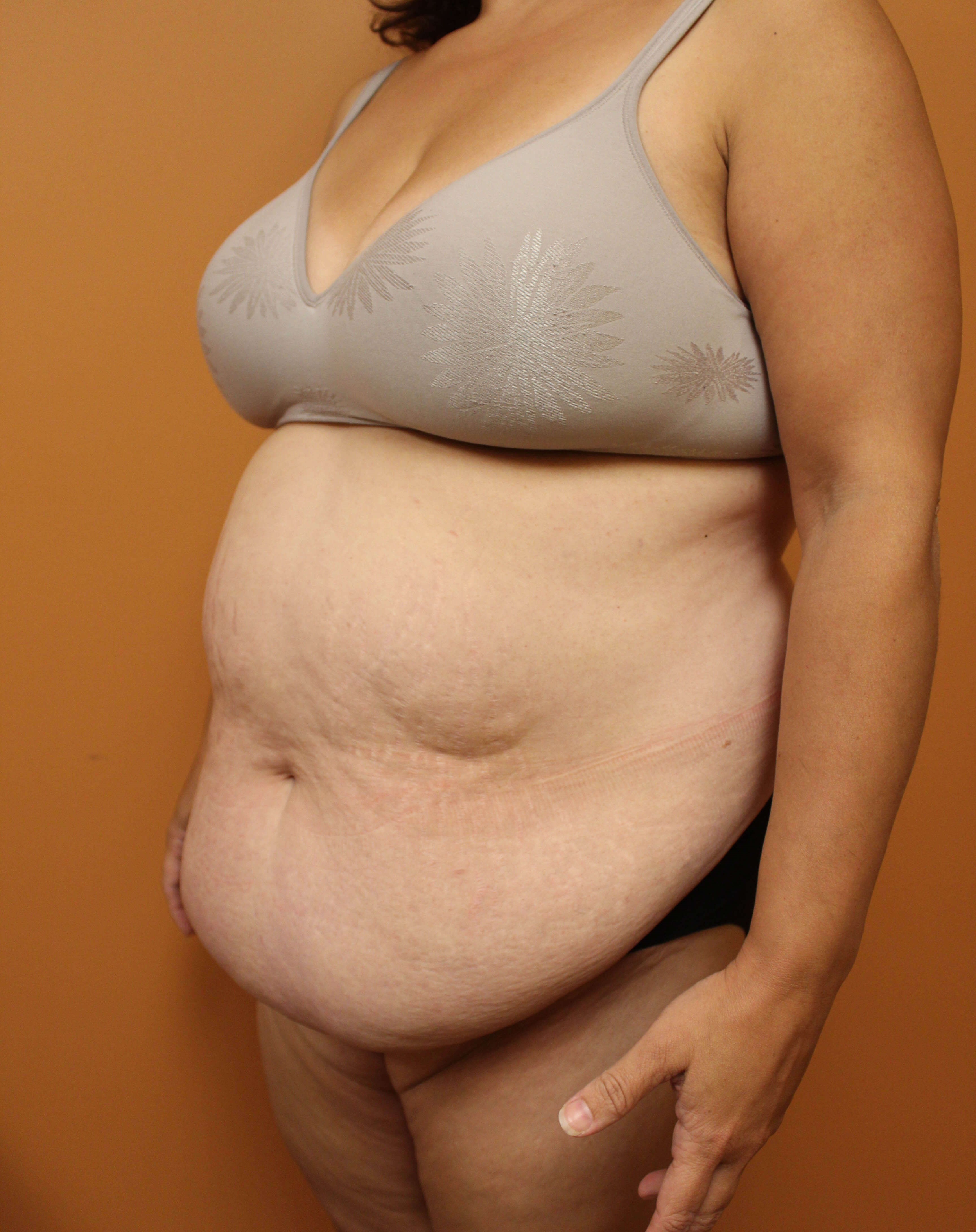 Tummy Tuck Surgery Before