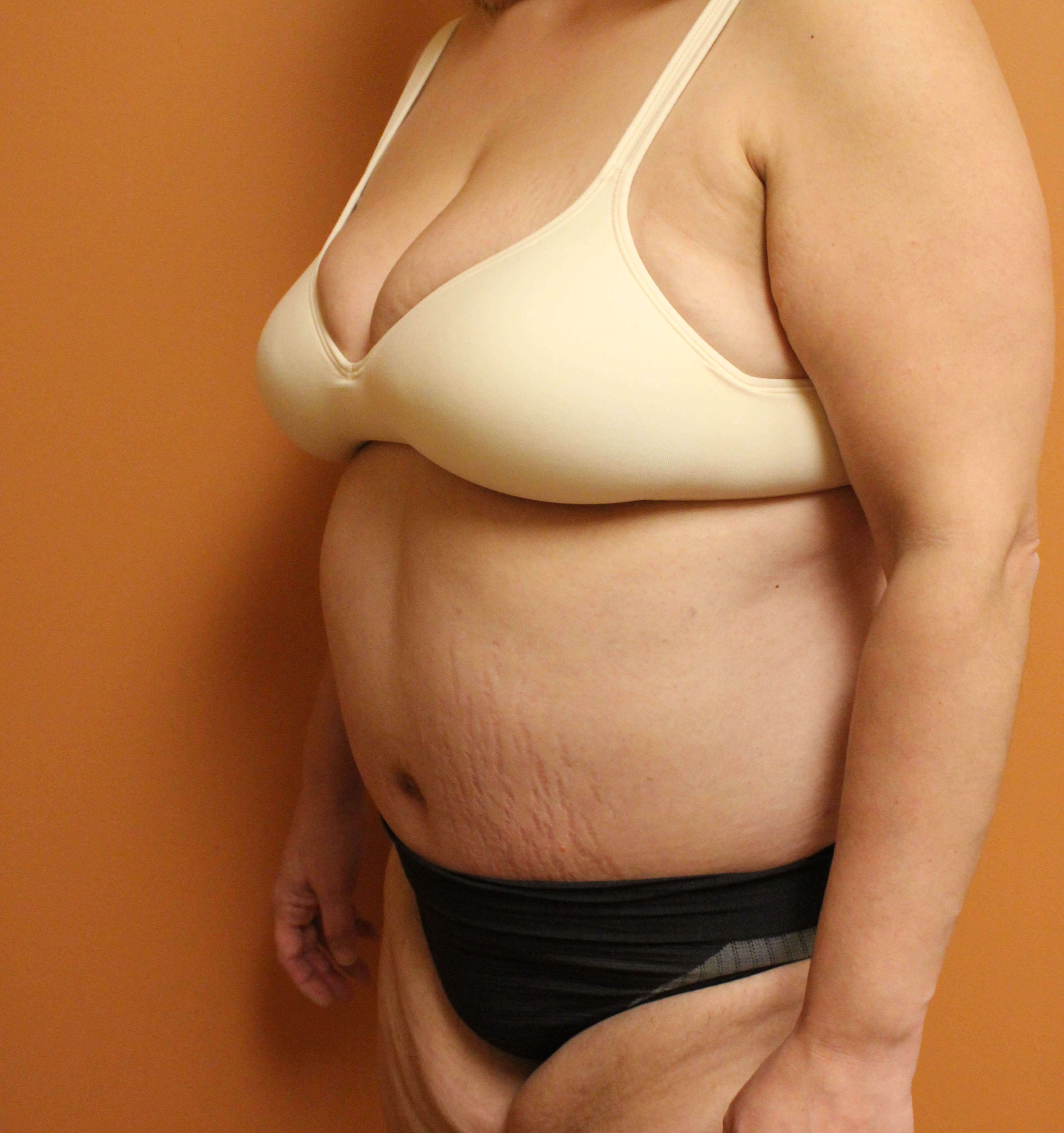 Tummy Tuck Surgery After