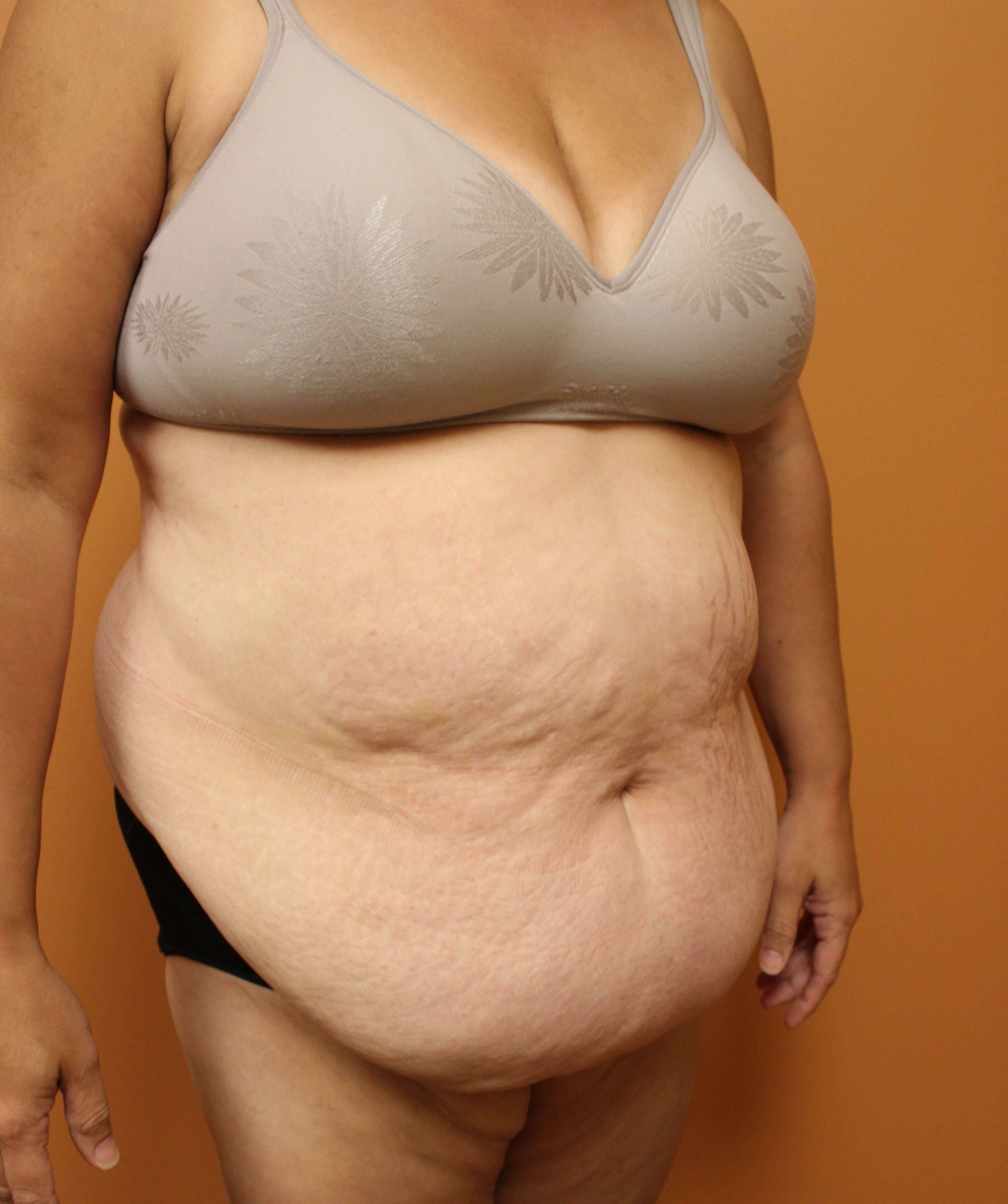Tummy Tuck Surgery Before